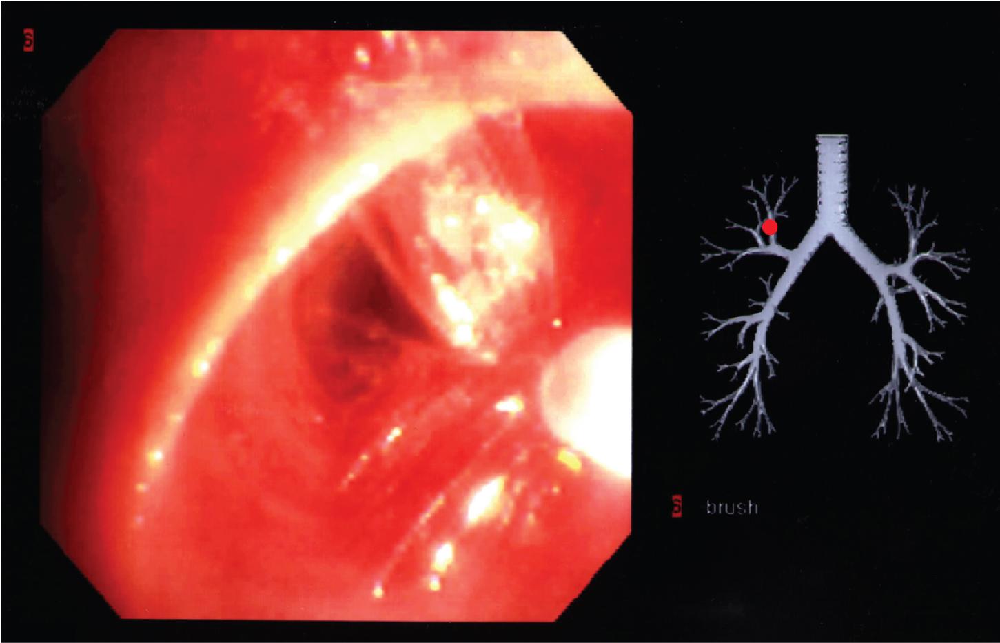 Figure 3.13, Bronchial brushing. Application of the brush to the airway mucosa.