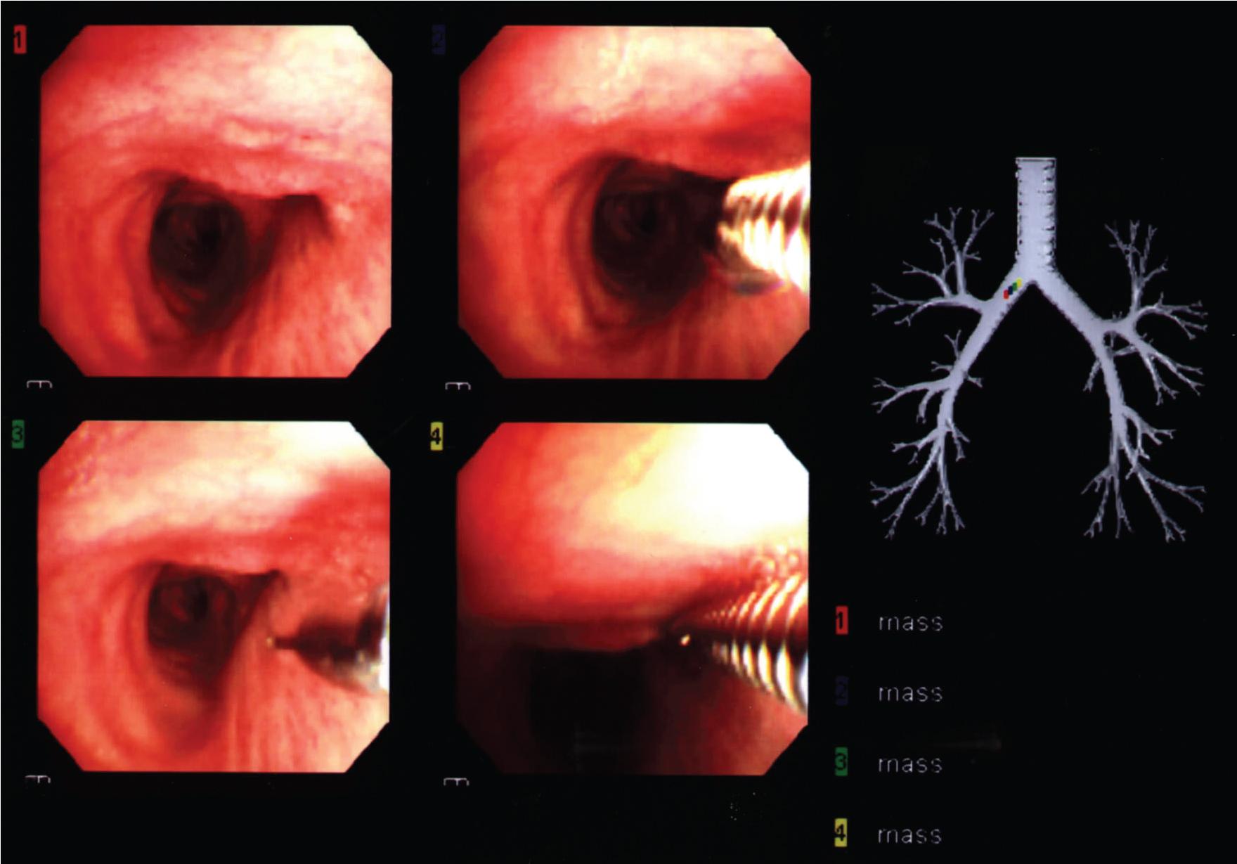 Figure 3.2, Bronchoscopy. Endoscopic view of right main bronchus with a needle biopsy device inserted ( right upper and lower images and left lower image ). Note the guide diagram (extreme right) , with a red dot indicating the position of the bronchoscope tip.