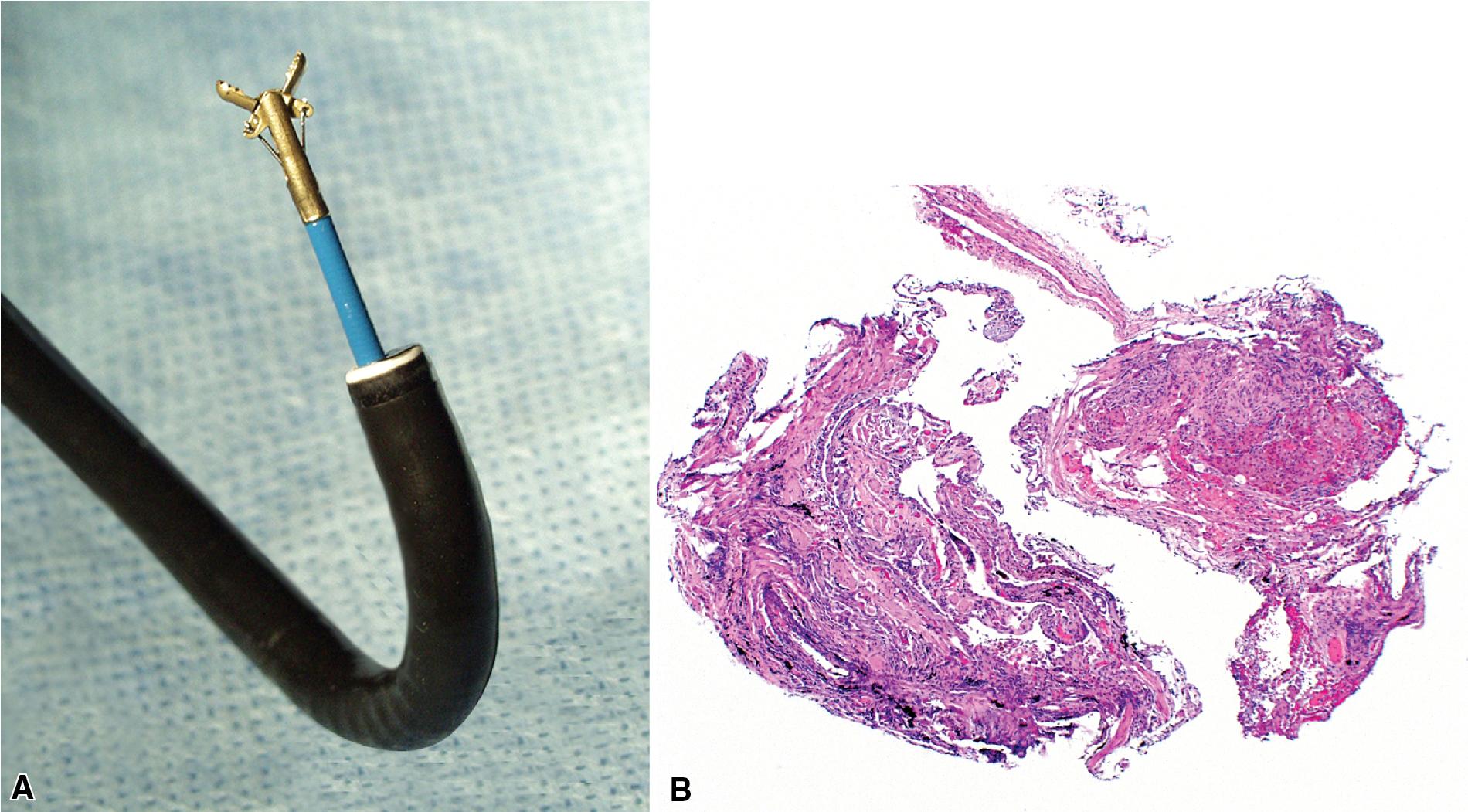 Figure 3.3, Bronchoscopic biopsy. (A) Cupped biopsy forceps. (B) Bronchoscopic biopsy specimen. The airway epithelium, subepithelial tissue, and muscle wall are typically present with variable cartilage.