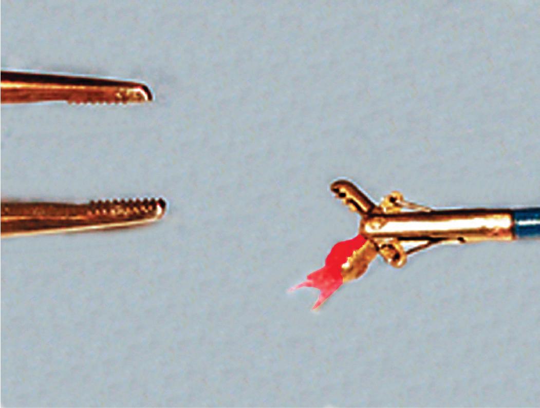 Figure 3.4, Bronchoscopic biopsy. Removing the specimen from the device with fine-tipped forceps is not advised. Alternatively, a sterile needle can be used.