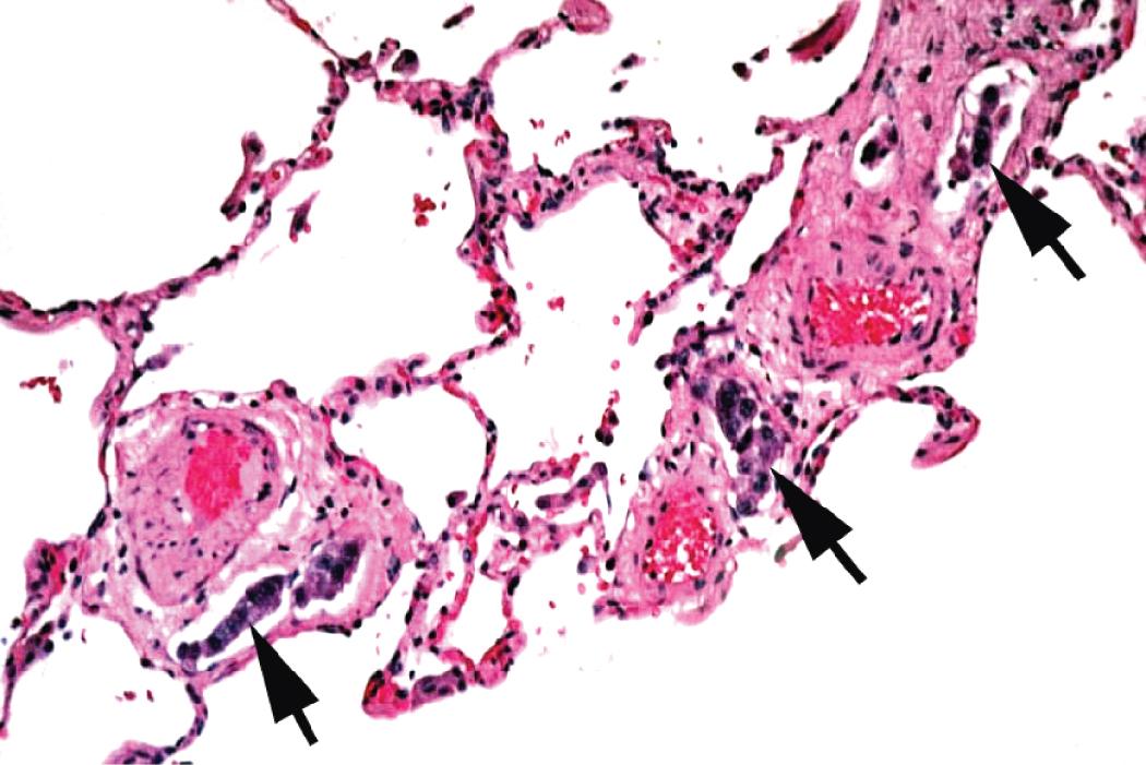 Figure 3.5, Lymphangitic carcinoma. Transbronchial biopsy specimen showing lymphangitic carcinoma (arrows) in dilated lymphatic channels included in the sample.