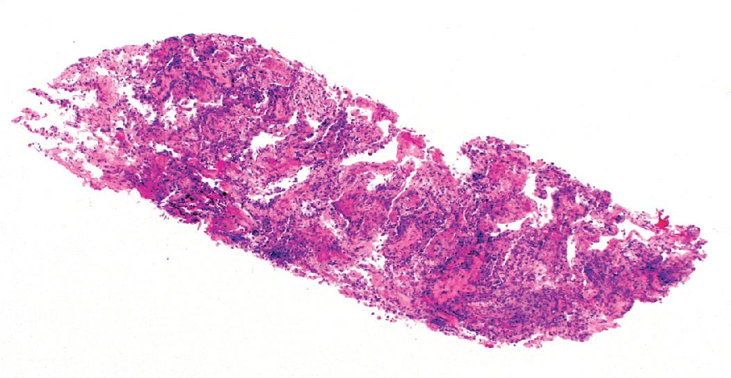 Figure 3.8, Transbronchial biopsy. Low-magnification image of a transbronchial biopsy specimen of generous size.