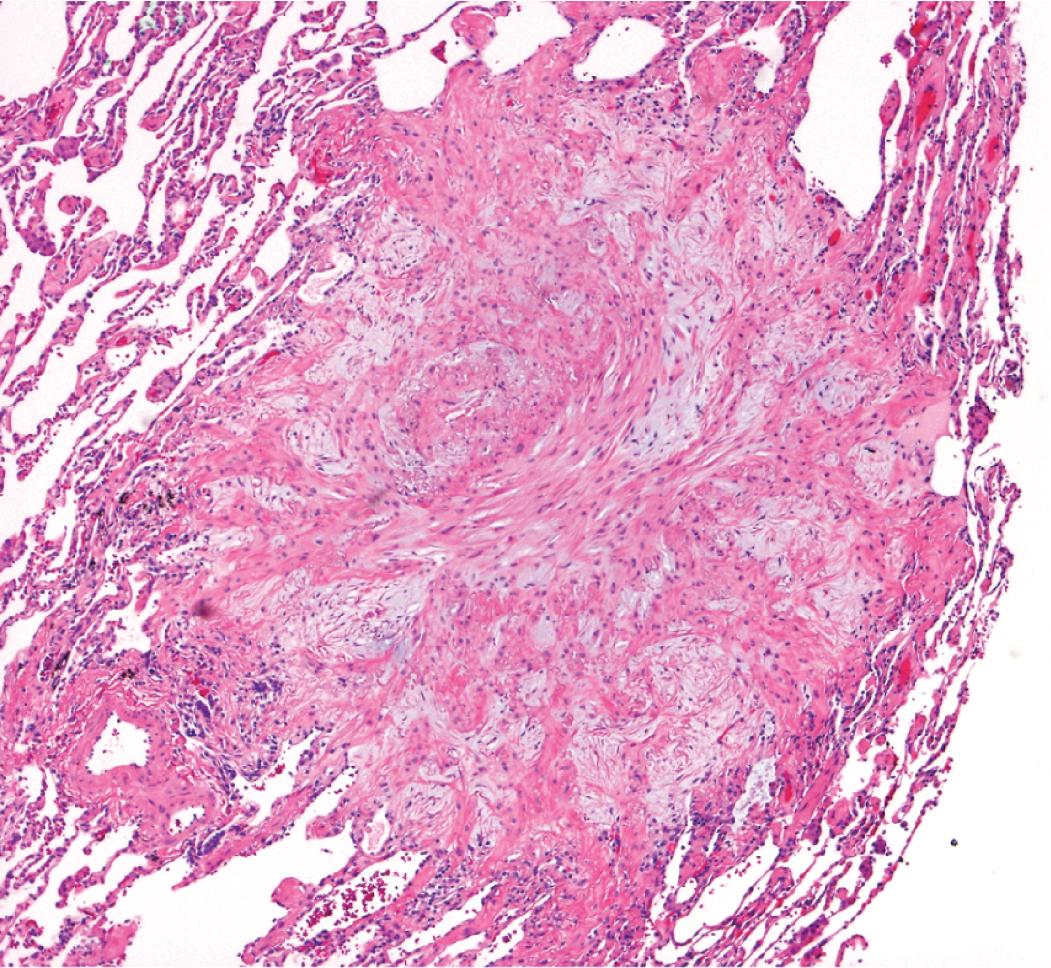 Figure 3.9, Organizing pneumonia and fibroplasia approximately 1 month after transbronchial biopsy. This patient was profoundly hypoxic and had bilateral mosaic perfusion suggestive of constrictive bronchiolitis. Transbronchial biopsies were negative for interstitial lung disease, and the patient underwent surgical lung biopsy.