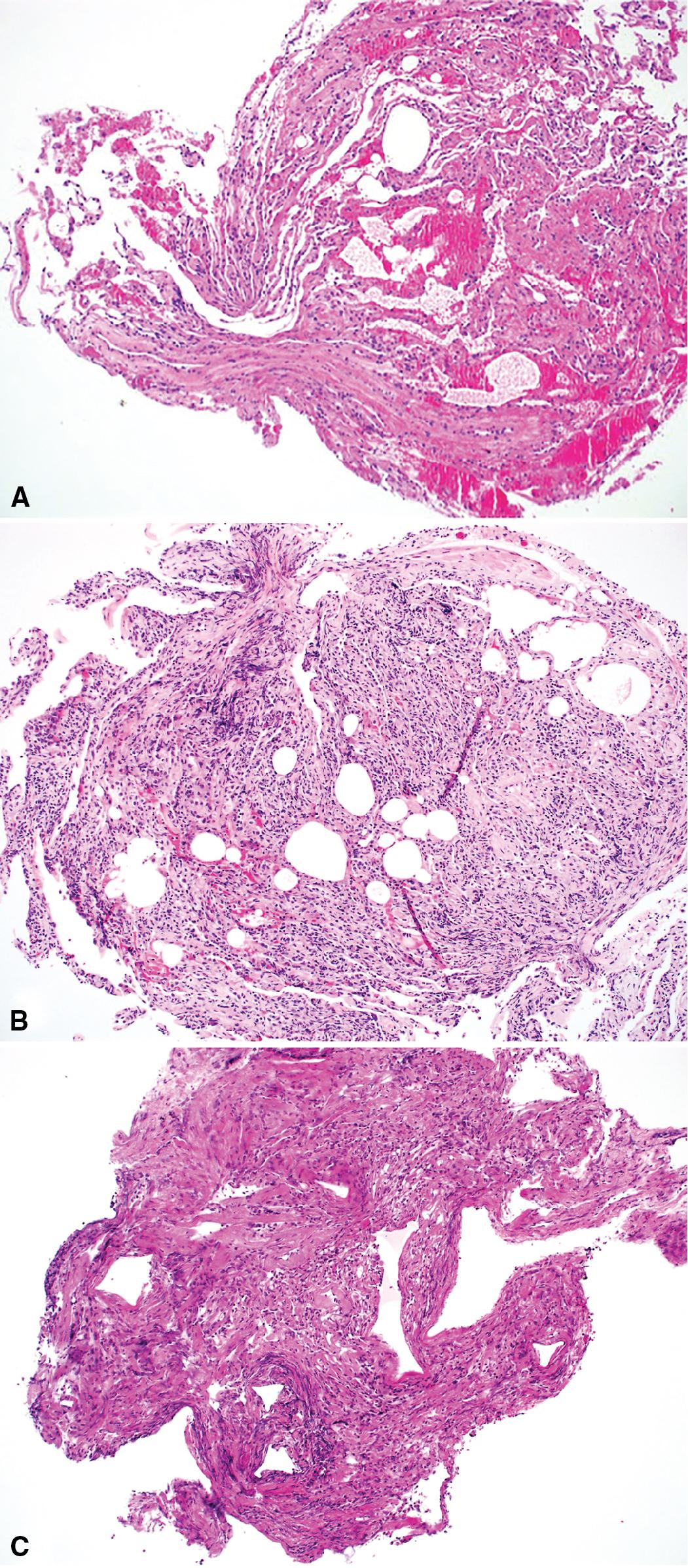 Figure 3.10, A variety of artifacts are encountered in the setting of transbronchial biopsies. (A) Due to the use of forceps, nearly all biopsy fragments have the potential to show crush artifact. (B) Biopsies fixed without any agitation may show bubble artifact that can be confused with lipoid pneumonia. (C) Processing lung biopsy specimens between sponges should be avoided because the sponge can create irregular punched-out spaces in the biopsy with severe associated compression.