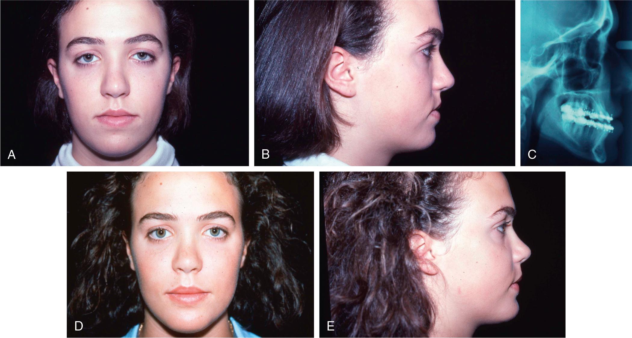 Fig. 16.1, This patient had a class III jaw relationship, and her occlusion could have been corrected by a LeFort I osteotomy (A–C). However, examination suggested that optimal soft tissue support and facial divergence would be accomplished with a bimaxillary advancement while correcting the malocclusion (D, E).