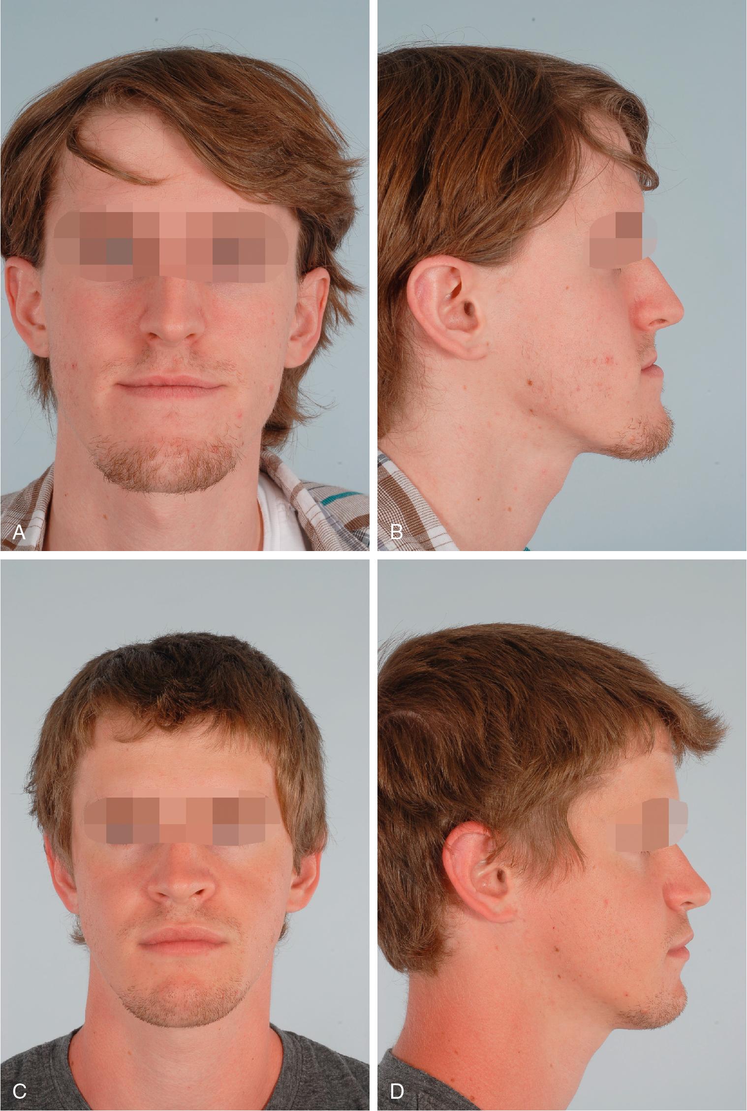 Fig. 16.2, This patient had a normal sella–nasion–A point (SNA) and an excessive sella–nasion–B point (SNB) on cephalometric analysis (A, B). Achieving cephalometric norms by normalizing the SNB with a mandibular setback would have compromised facial aesthetic facial form. An alternative approach of a LeFort I advancement and setback genioplasty corrected his occlusion, enhanced the aesthetic form, and yet achieved the result by defying cephalometric norms (C, D).