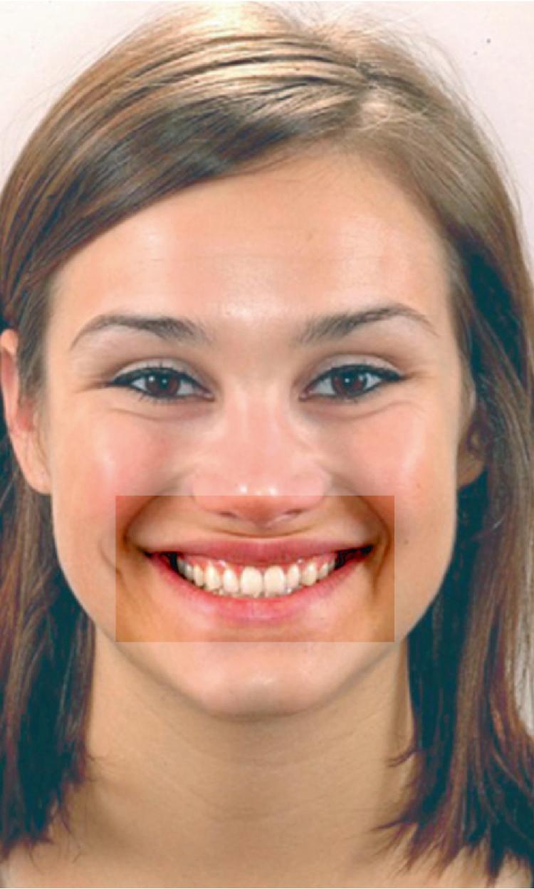 Fig. 19.1, The smile itself should be considered an aesthetic subunit. It is the interface between the dentofacial skeleton and the soft tissue envelope of the face that is the most visible.