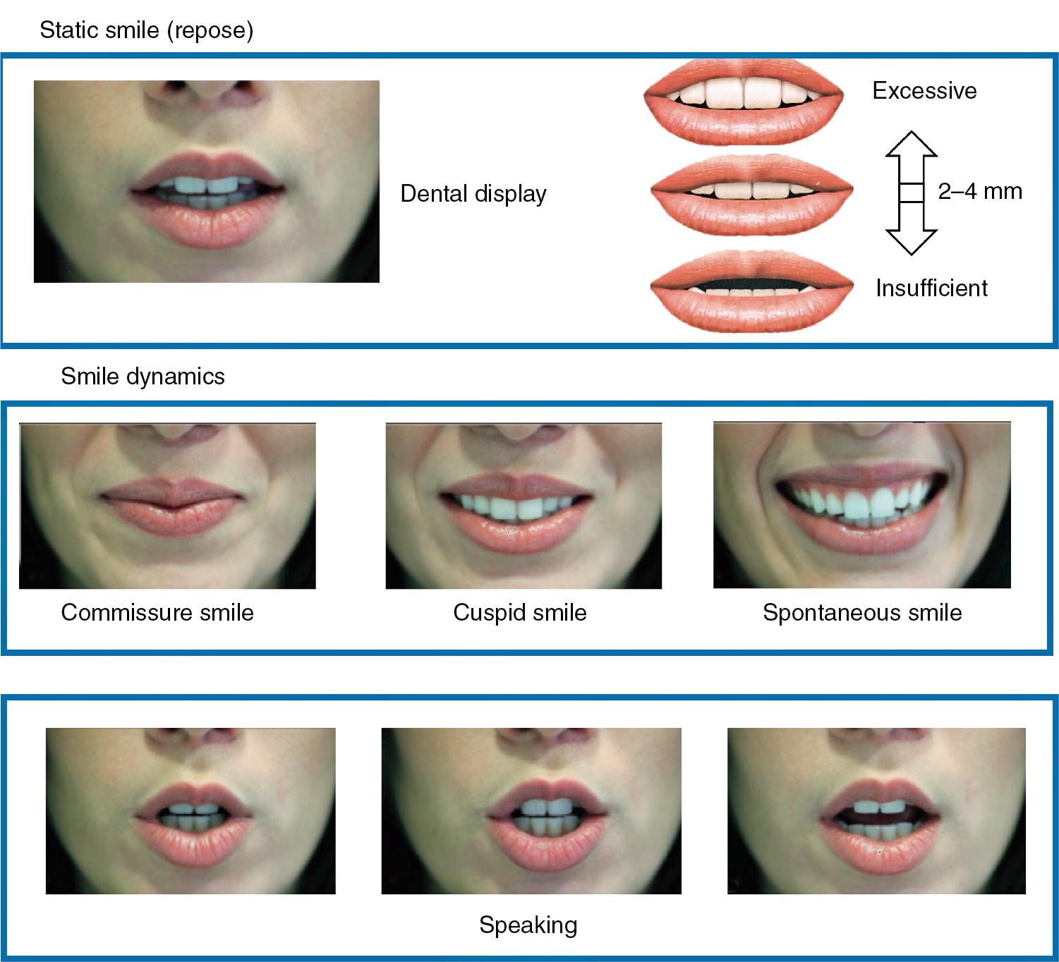 Fig. 19.2, The vertical dynamics of the lip–incisor relationship. When the lips are at rest or repose, the dental display ranges typically from 2 to 4 mm. With function, there are different degrees of incisor exposure during speaking and smiling. This is best captured through videos. Because of the numerous variables that need to be controlled, one of the challenges in the planning of orthodontic treatment combined with orthognathic surgical treatment is achieving consistently optimal smile aesthetics.