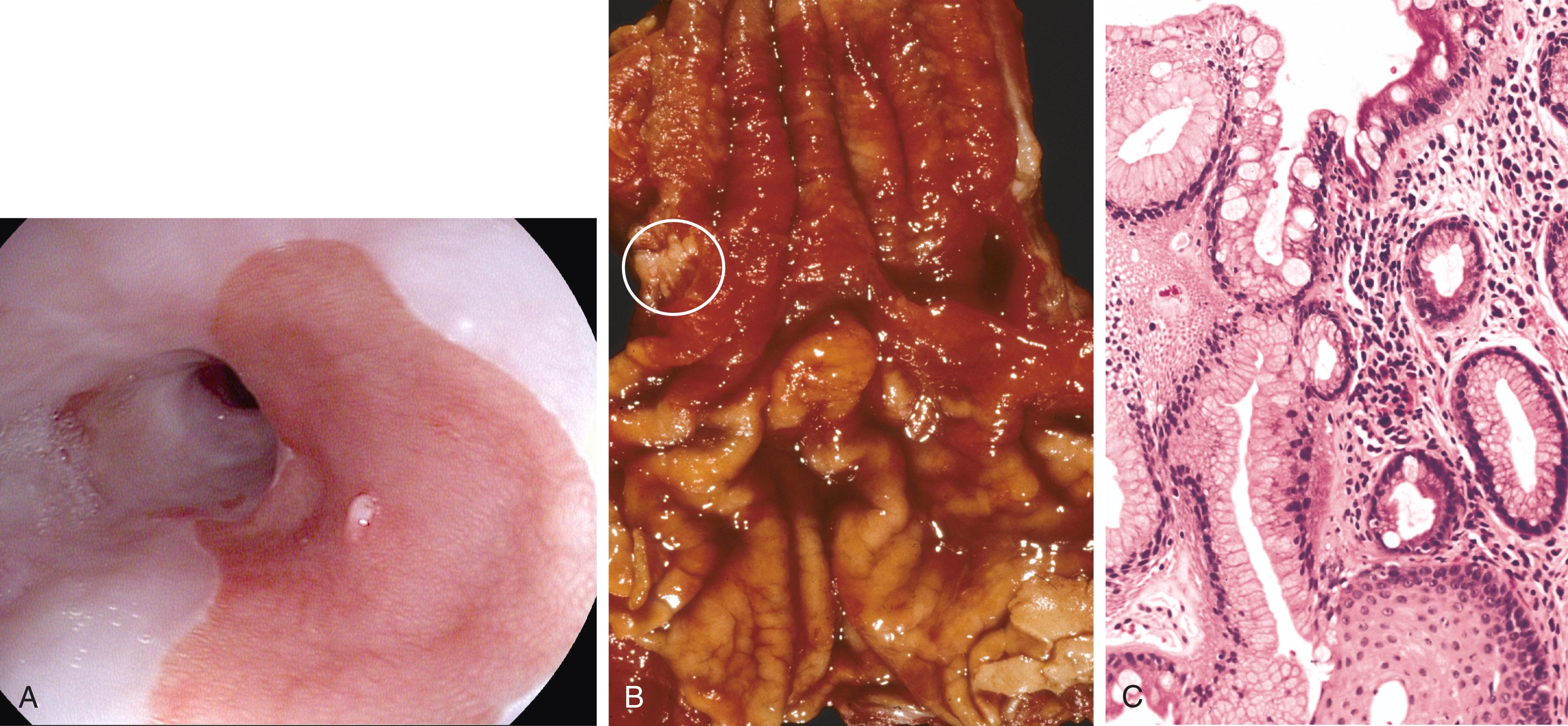 FIG. 13.10, Barrett esophagus. (A) Barrett esophagus at endoscopy, seen as a patch of reddish mucosa. (B) Gross image of Barrett esophagus (compare to Fig. 13.7 C). Only a focal area of paler squamous mucosa (circle) remains within the predominantly metaplastic, reddish mucosa of the distal esophagus. (C) Histologic appearance of the gastroesophageal junction in Barrett esophagus. Note the transition between esophageal squamous mucosa (lower right) and metaplastic mucosa containing goblet cells (upper) .