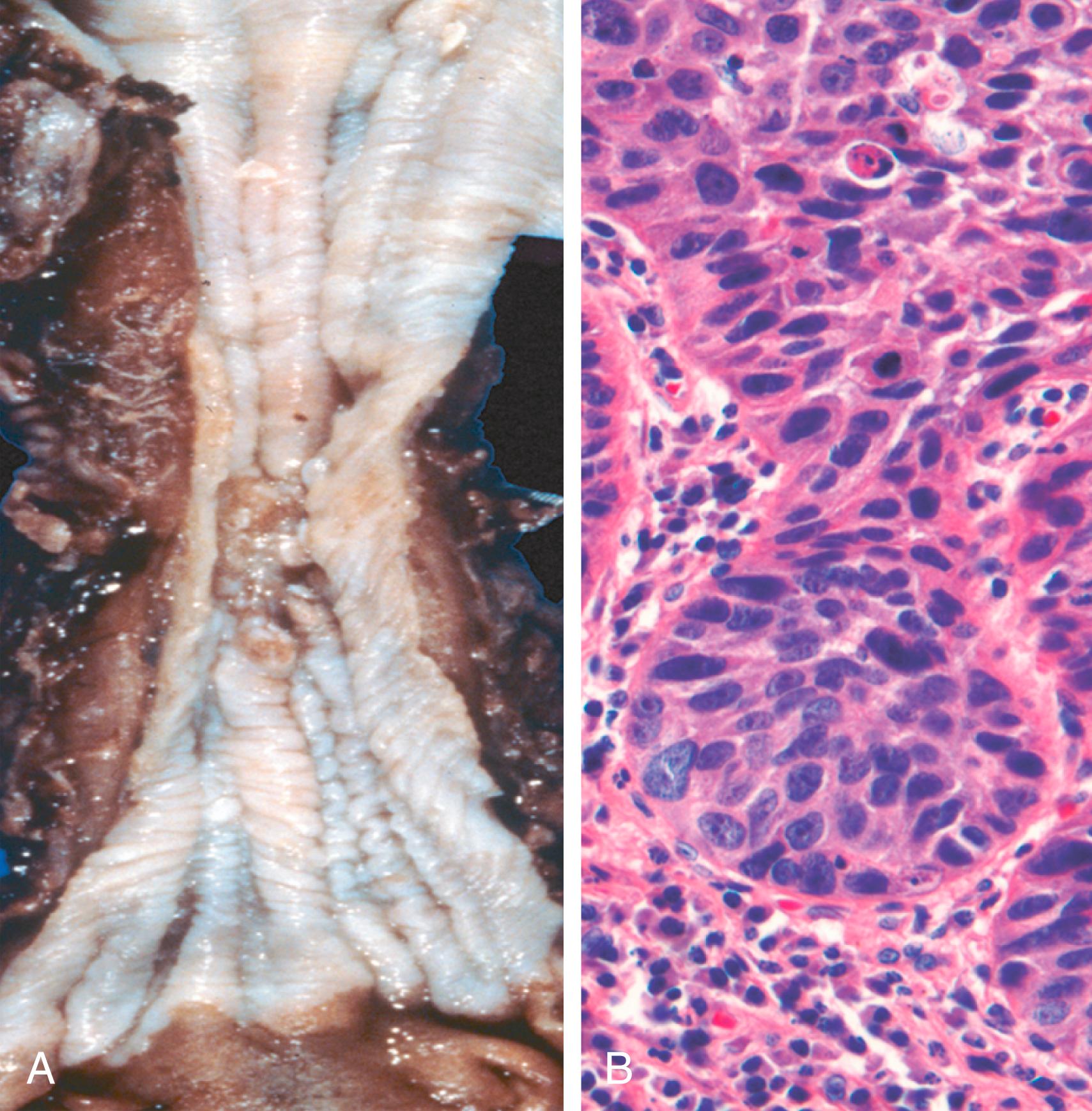 FIG. 13.12, Esophageal squamous cell carcinoma. (A) Squamous cell carcinoma most frequently is found in the mid esophagus, where it commonly causes strictures. (B) Squamous cell carcinoma composed of nests of malignant cells that partially recapitulate the stratified organization of squamous epithelium.