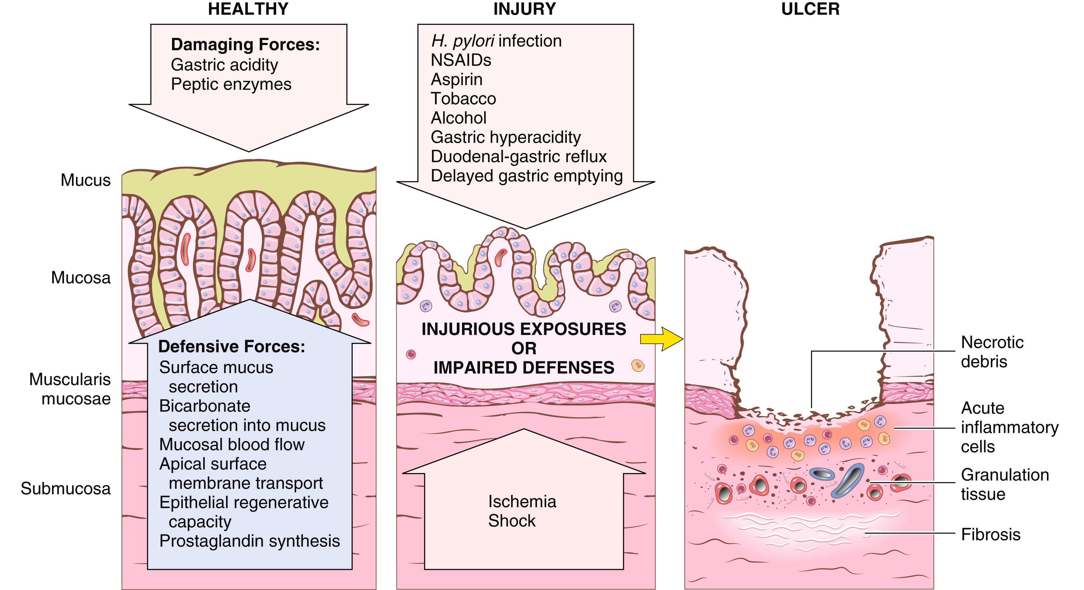 FIG. 13.13, Mechanisms of gastric injury and protection. This diagram illustrates the progression from mild forms of injury to ulceration that may occur with acute or chronic gastritis. Ulcers include layers of necrotic debris, inflammation, and granulation tissue; scarring, which develops over time, is present only in chronic lesions. NSAIDs, Nonsteroidal antiinflammatory drugs.