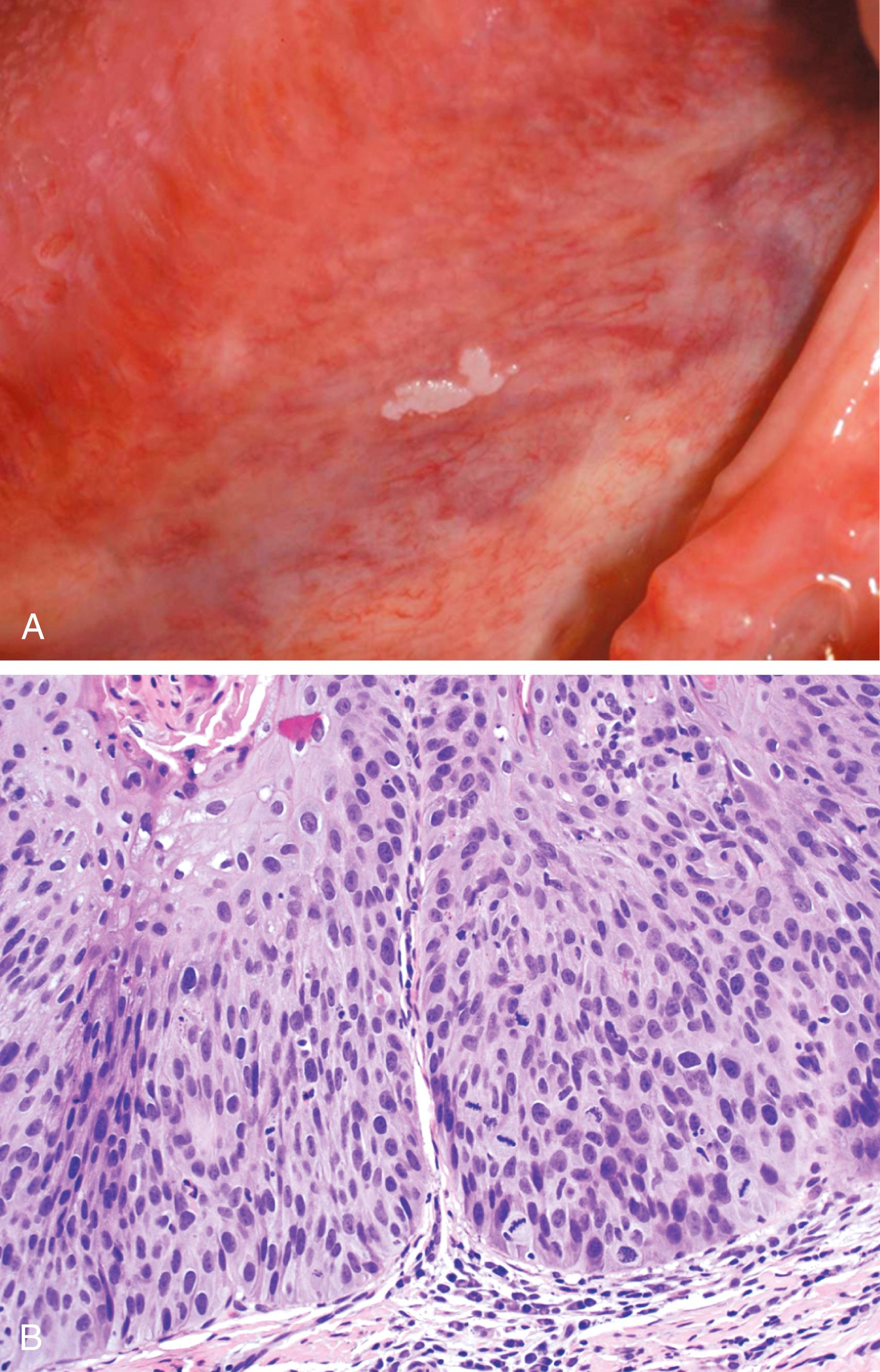 FIG. 13.3, Leukoplakia. (A) Gross appearance of leukoplakia is highly variable. In this example, the lesion is smooth with well-demarcated borders and minimal elevation. (B) Histologic appearance of leukoplakia showing dysplasia, characterized by nuclear and cellular pleomorphism and loss of normal maturation.