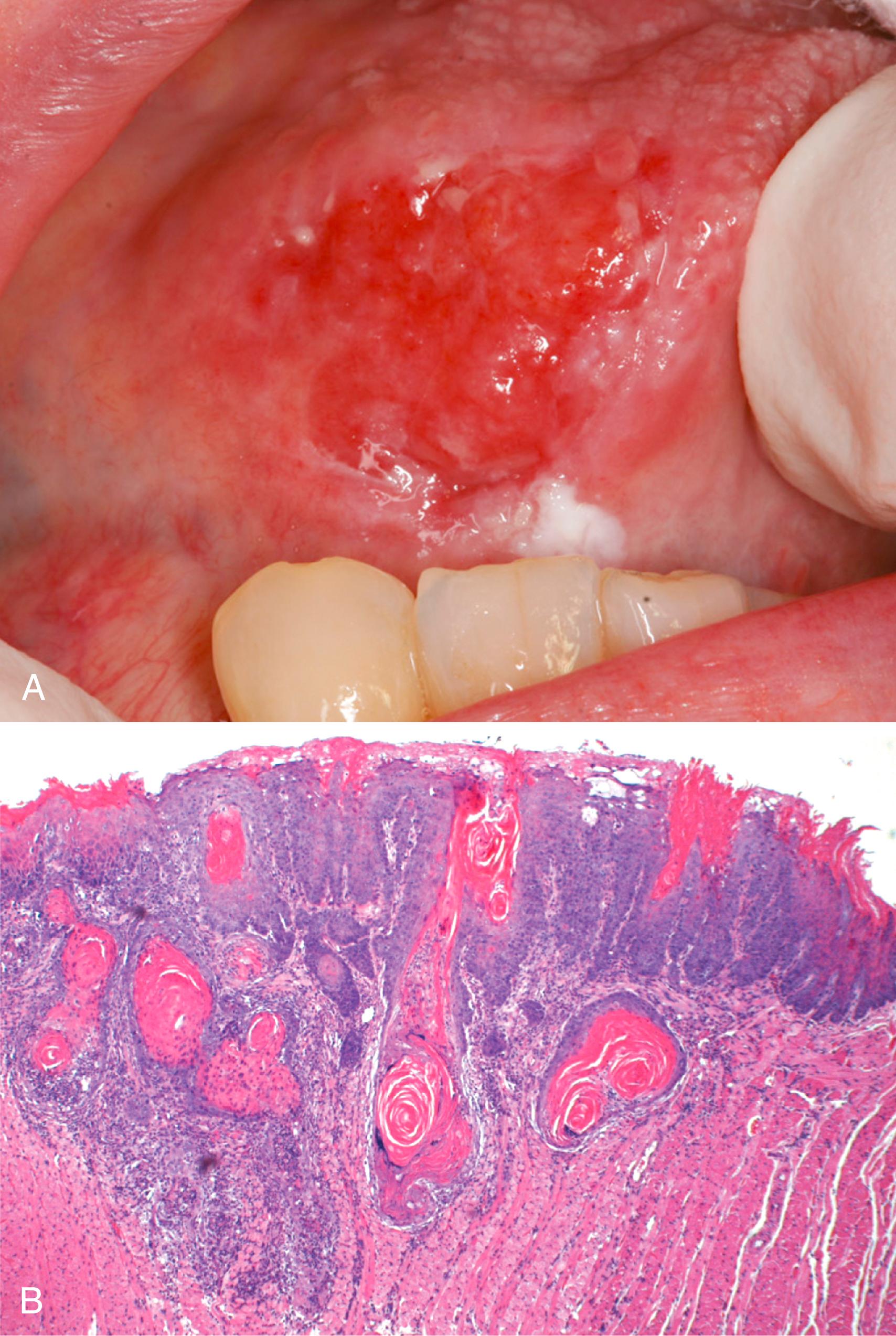 FIG. 13.4, Oral squamous cell carcinoma. (A) Gross appearance demonstrating ulceration and induration of the oral mucosa. (B) Histologic appearance showing numerous nests and islands of malignant keratinocytes invading the underlying connective tissue stroma.