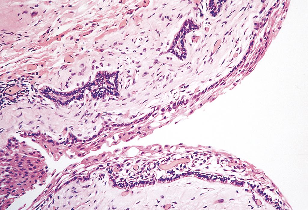 eFIG. 13.2, Ameloblastoma. Cyst formation in ameloblastoma. The columnar epithelium underlies areas of squamous differentiation and overlies a sparsely cellular stroma containing stellate cells.