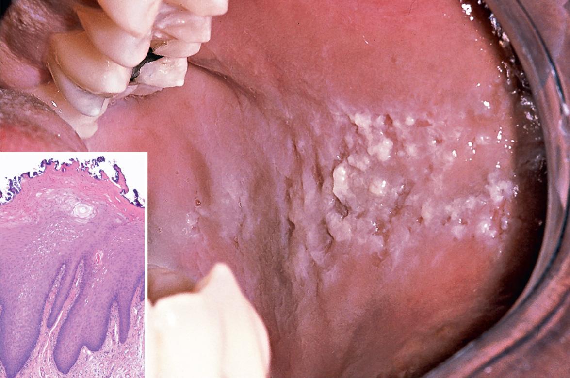 Fig. 72.11, Cheek chewing (morsicatio buccarum) – clinical and histopathologic findings.