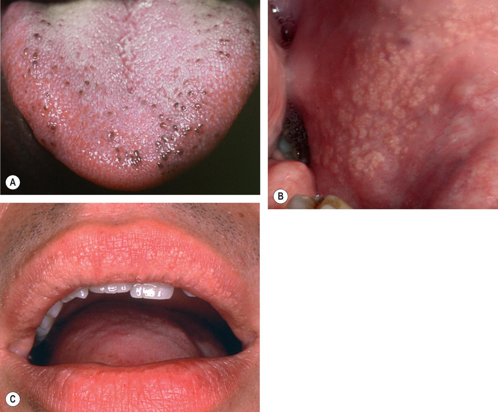 Fig. 72.2, Variations of normal anatomy – Fordyce granules and pigmented papillae of the tongue.