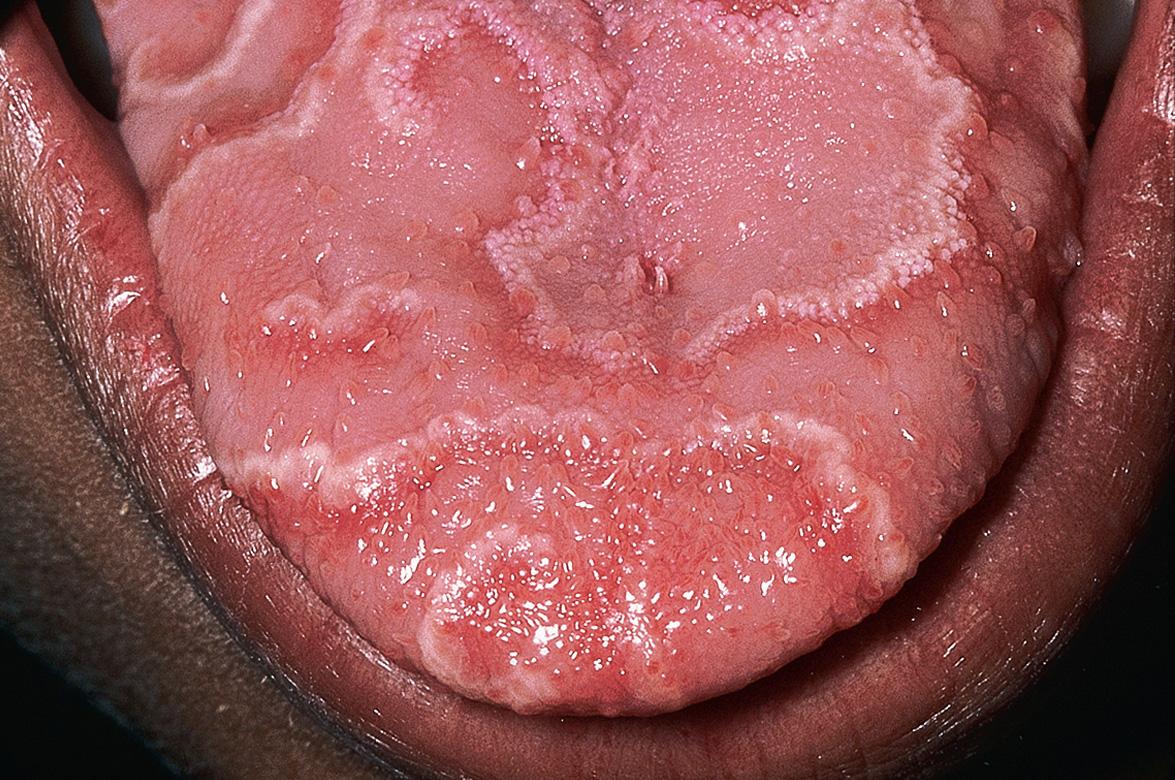 Fig. 72.3, Geographic tongue.