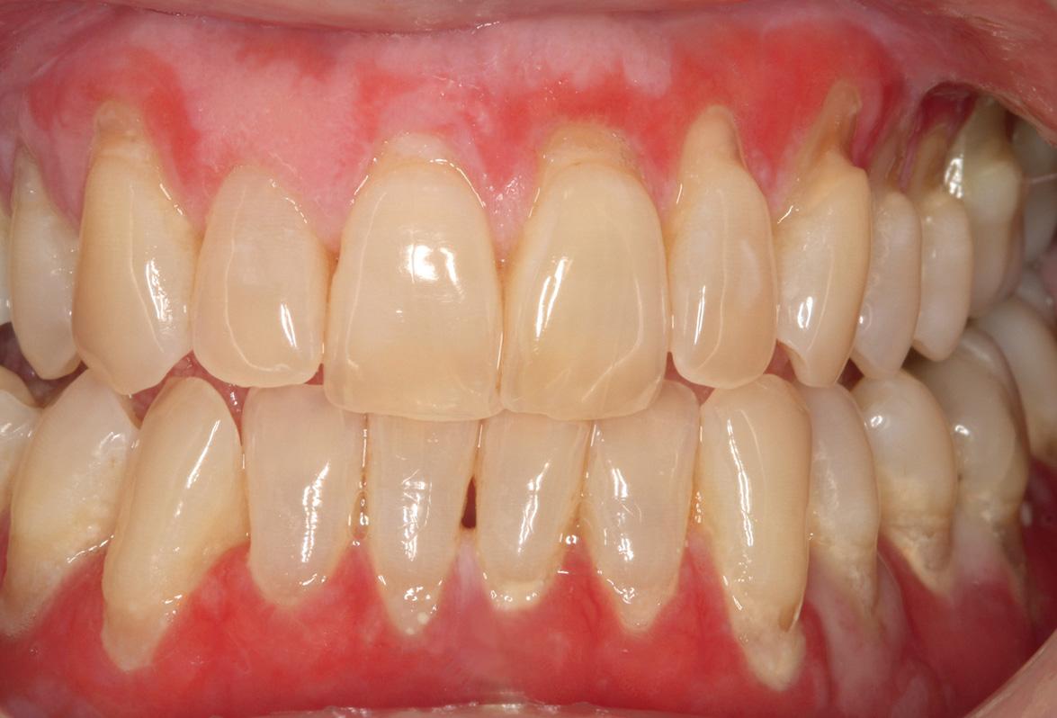 Fig. 72.8, Desquamative gingivitis due to oral erosive lichen planus.