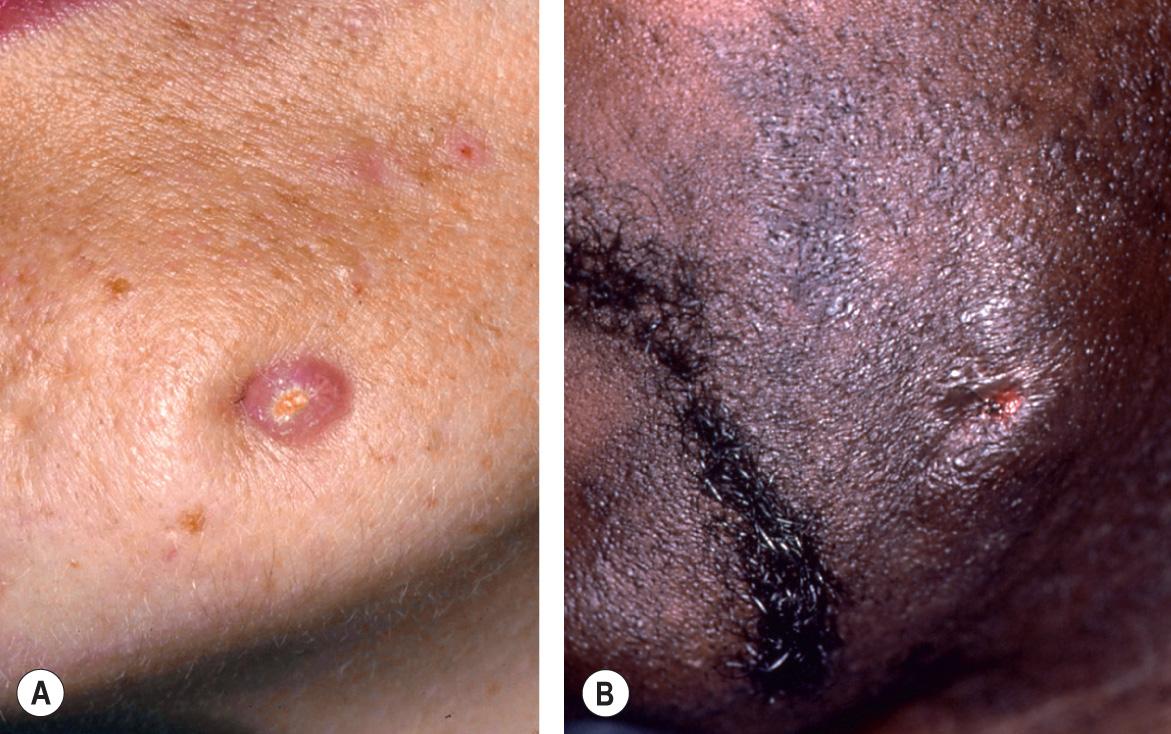 Fig. 72.9, Cutaneous sinus of dental origin.