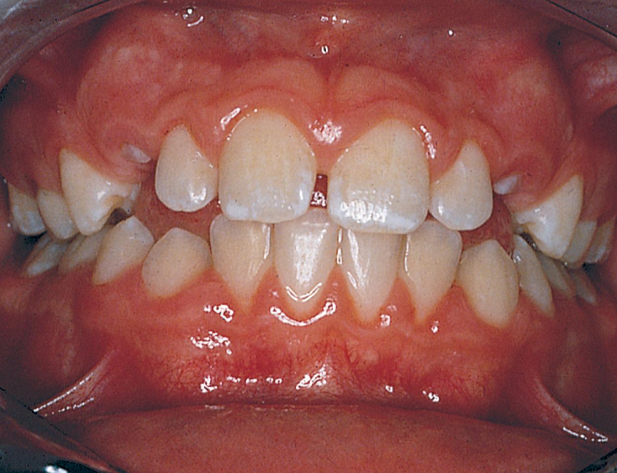 Fig. 21.8, The earliest stage of permanent dentition begins with the eruption of the 6-year molars and central incisors. The cuspids and second molars are the last to erupt.