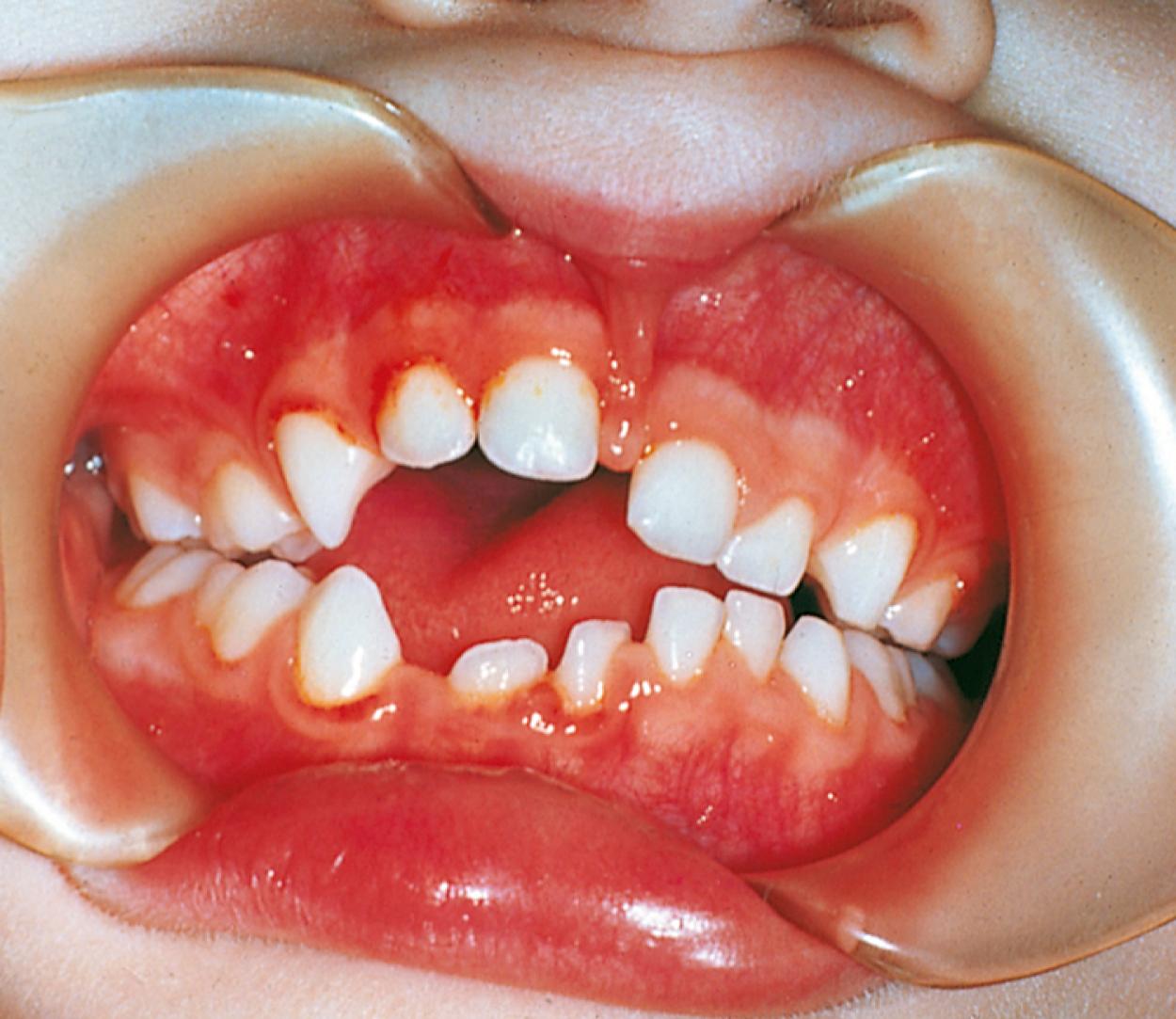 Fig. 21.13, A 2-year-old with a prolonged pacifier-sucking habit has severe deformity of the alveolar arches and teeth caused by the extrinsic force of the pacifier-sucking action.