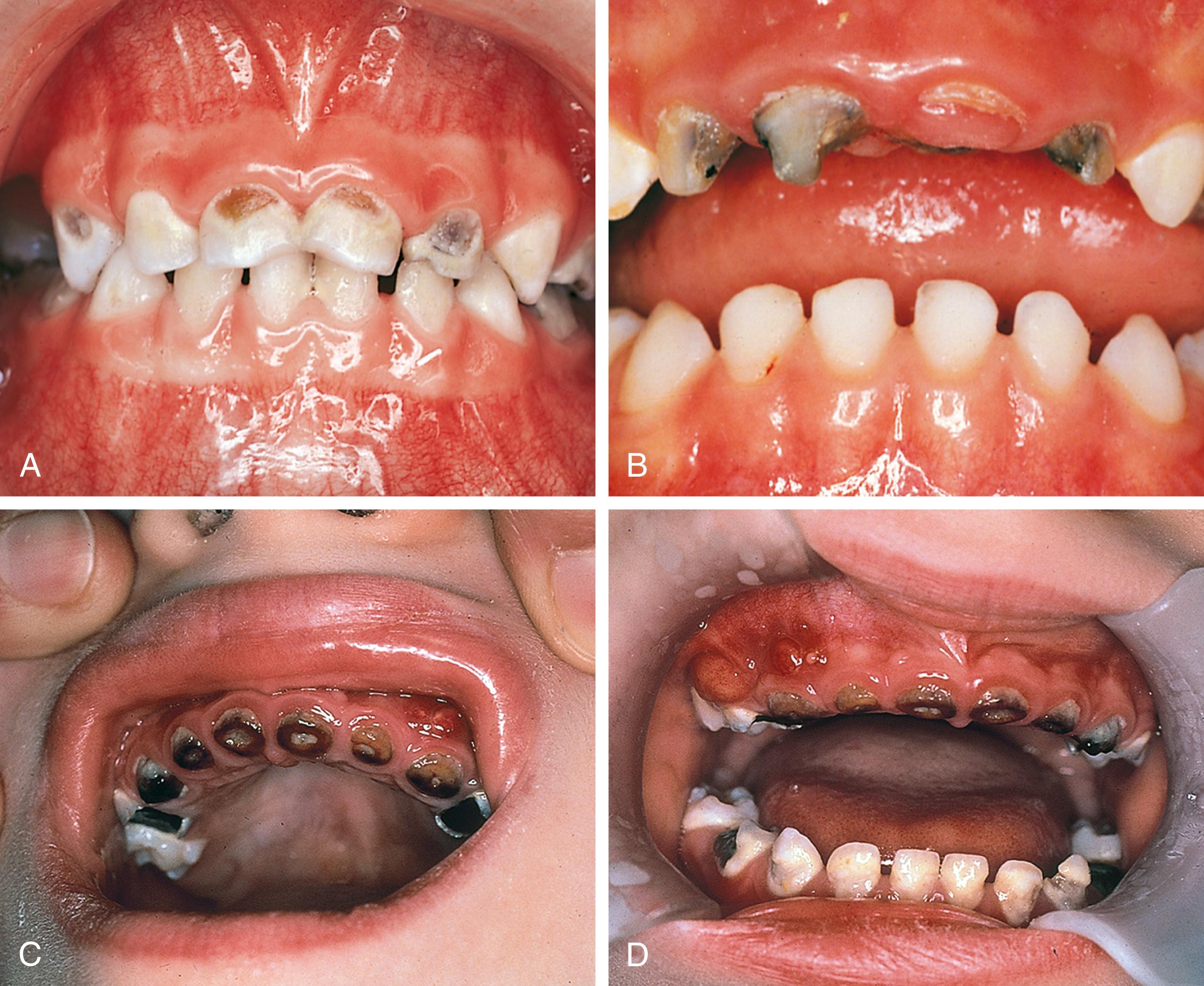 Fig. 21.42, Caries. (A) The typical pattern of nursing bottle caries, with the upper incisors being the first involved. (B) When badly neglected, severe tooth erosion occurs, and periapical abscesses may develop. (C) and (D) This 3-year-old victim of medical and dental neglect represents the extreme end of the spectrum of nursing bottle caries. When placed in foster care, she was still drinking from a bottle, had never had her teeth brushed, and had never seen a dentist. (C) Marked discoloration, extreme wear, and carious destruction of her entire maxillary dentition are evident. (D) All of her upper teeth were abscessed and her mandibular teeth were severely decayed.