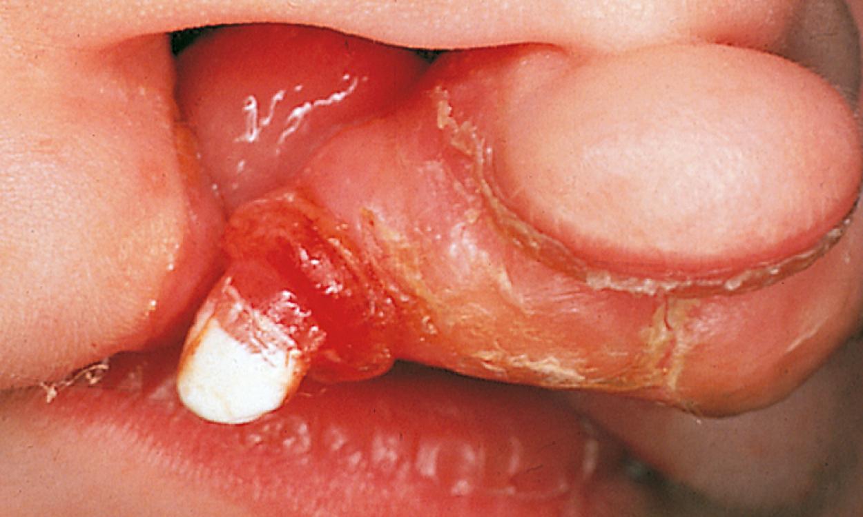 Fig. 21.14, A natal tooth associated with cleft palate. Extraction is necessary only if it is of abnormal morphology, causing feeding difficulties, or is an aspiration risk due to excessive mobility.