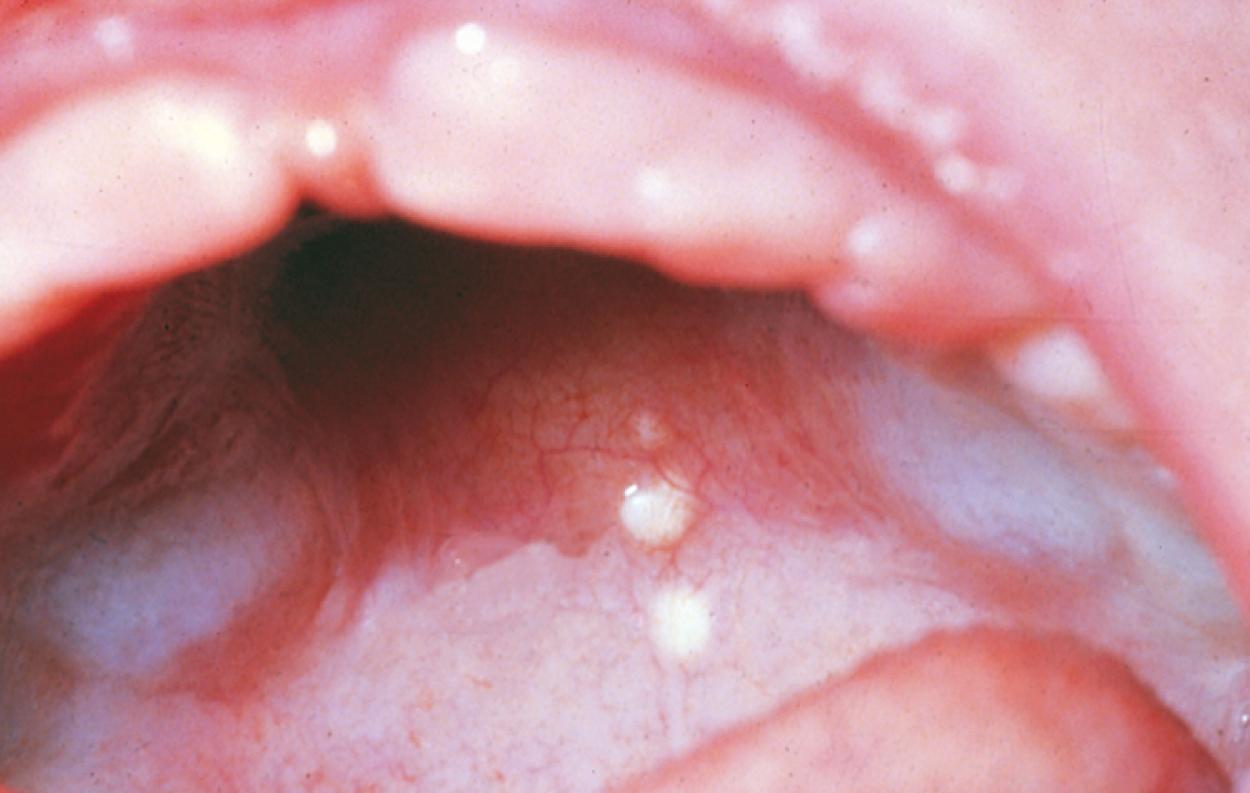 Fig. 21.15, Gingival cysts. The small, whitish cystic lesions seen along the midpalatine raphe are called Epstein pearls.
