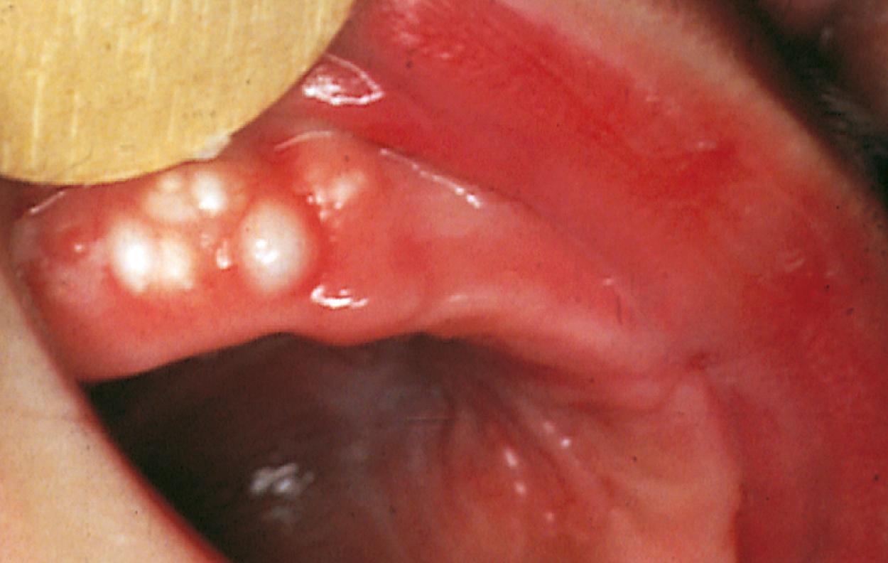Fig. 21.16, Gingival cysts. The firm, grayish-white mucous gland cysts on the buccal aspect of the alveolar ridges are called Bohn nodules.