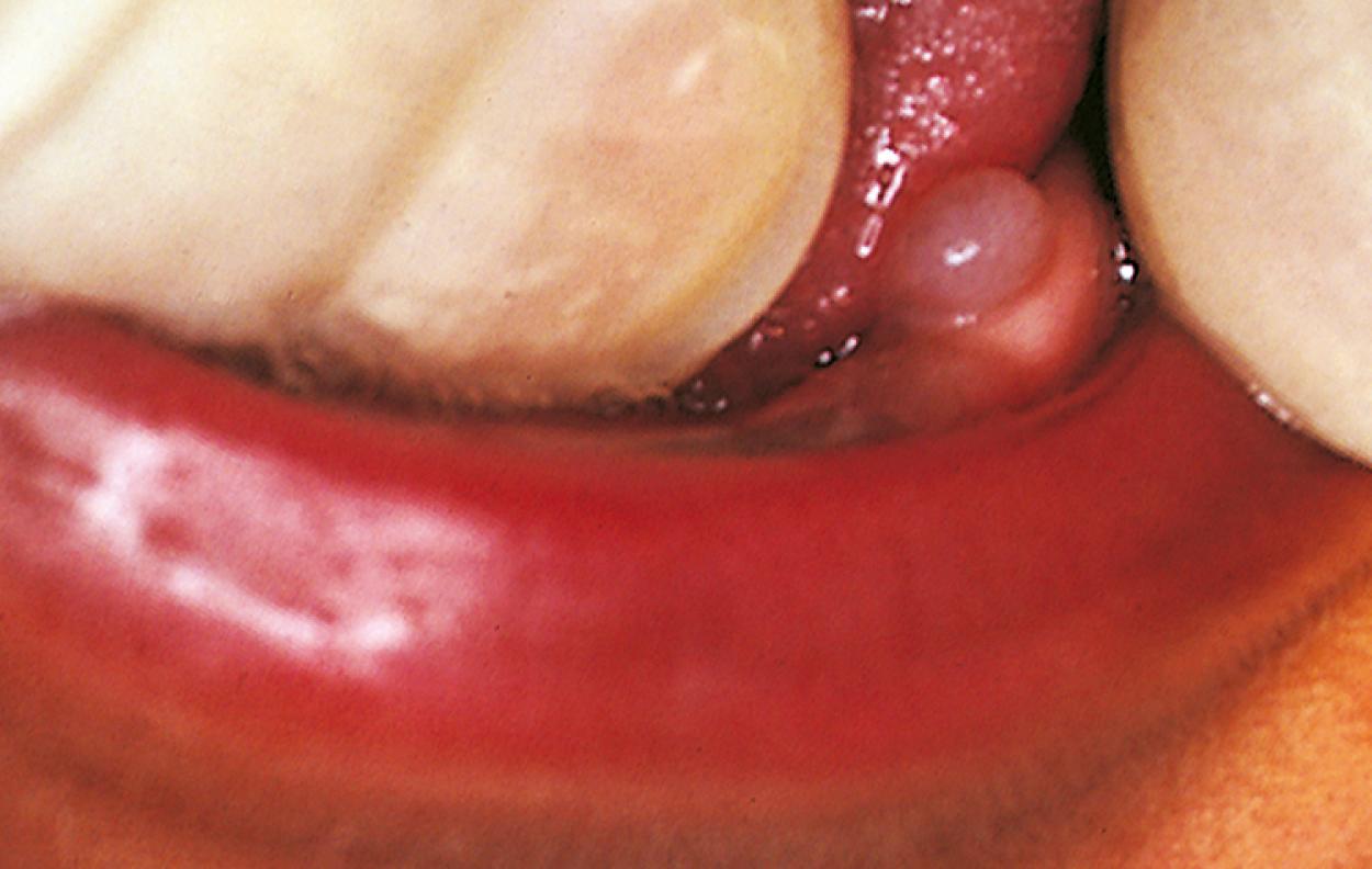 Fig. 21.17, Dental lamina cyst. These cysts are found on the alveolar ridge and usually occur singly.