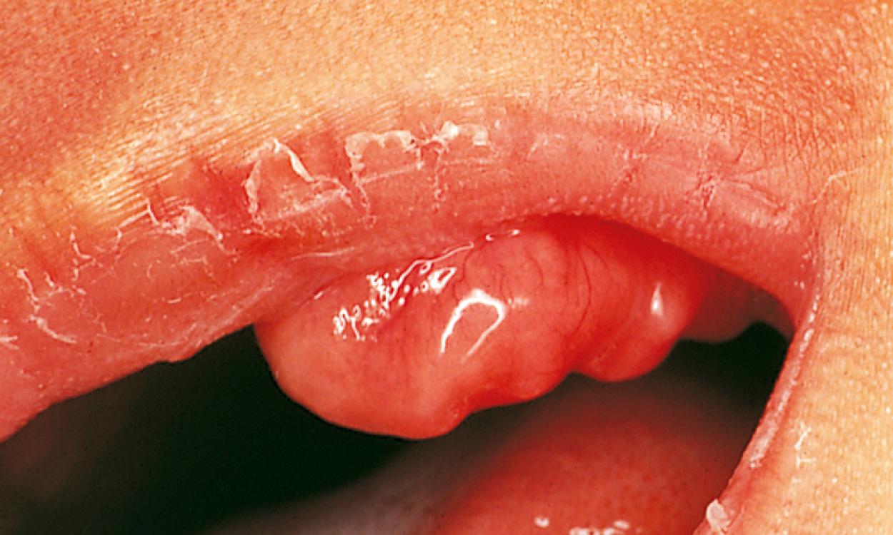 Fig. 21.18, Congenital epulis. This 4-day-old patient has a benign tumor of the anterior maxilla.