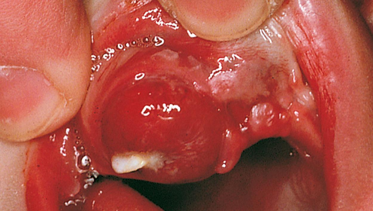 Fig. 21.19, Melanotic neuroectodermal tumor. This benign but locally aggressive tumor of the anterior maxilla has produced elevation of the lip and displaced a primary tooth.