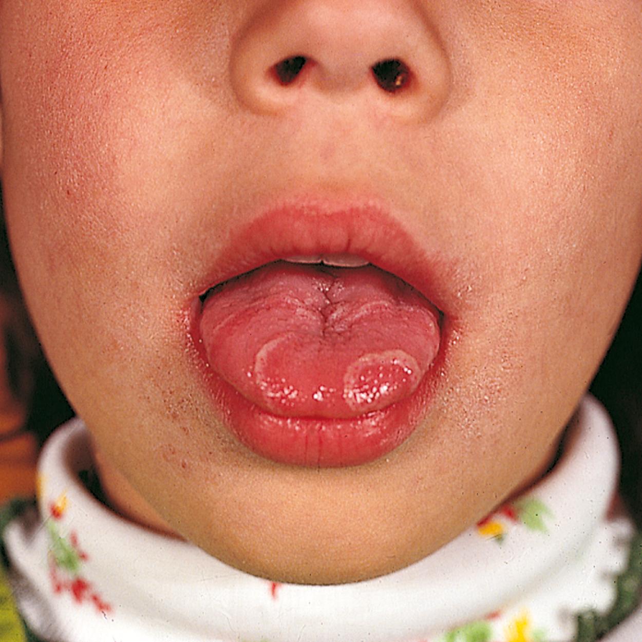 Fig. 21.20, Characteristics of benign migratory glossitis (geographic tongue), which is a chronic and often recurring condition affecting the filiform papillae of the tongue. Lesions are red, slightly depressed, and bordered by a whitish band.