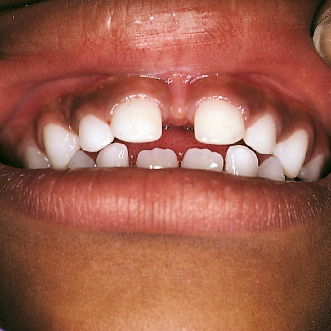 Fig. 21.21, Large diastema (excessive spacing) between the front teeth, secondary to an inferiorly positioned maxillary frenulum.