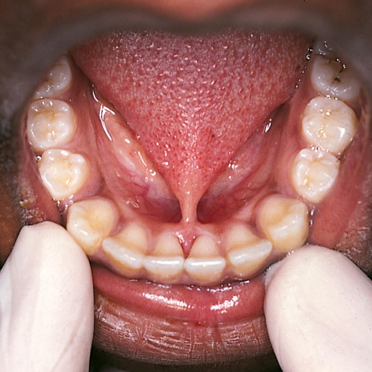 Fig. 21.22, Ankyloglossia. This extremely short lingual frenulum with a high insertion point on the gingival margin is an indication for surgical intervention.