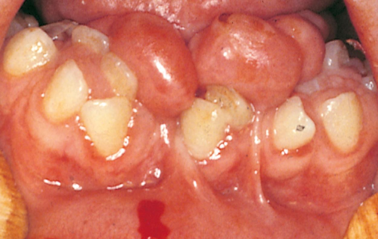 Fig. 21.23, Multiple hyperplastic frenula are seen in this patient with orofaciodigital syndrome. These frenula interfered with the eruption of teeth, causing rotation and crowding.