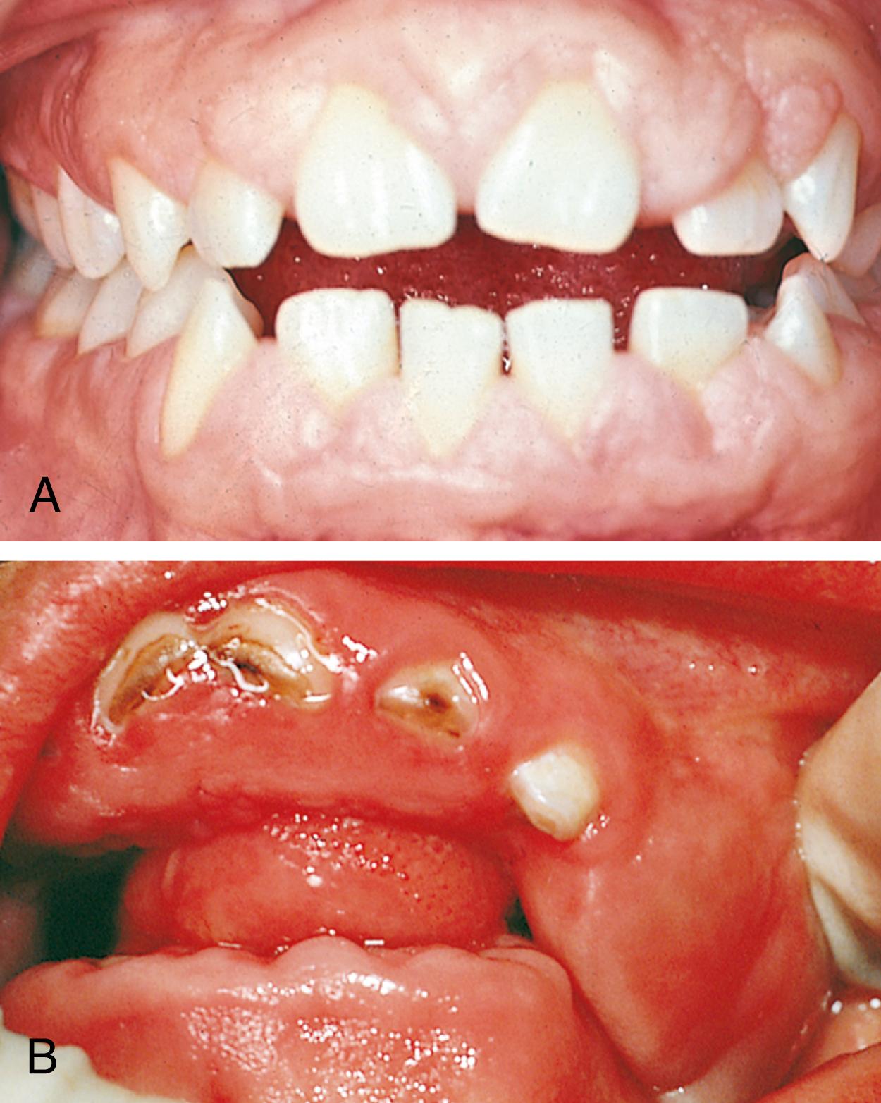 Fig. 21.24, Phenytoin-induced gingival overgrowth. (A) A typical gingival response (hyperplasia) to chronic phenytoin ingestion. Similar gum changes can result from cyclosporine therapy. (B) Severe overgrowth. The firm, hyperplastic gingival tissues have completely covered the posterior teeth and are interfering with mastication.