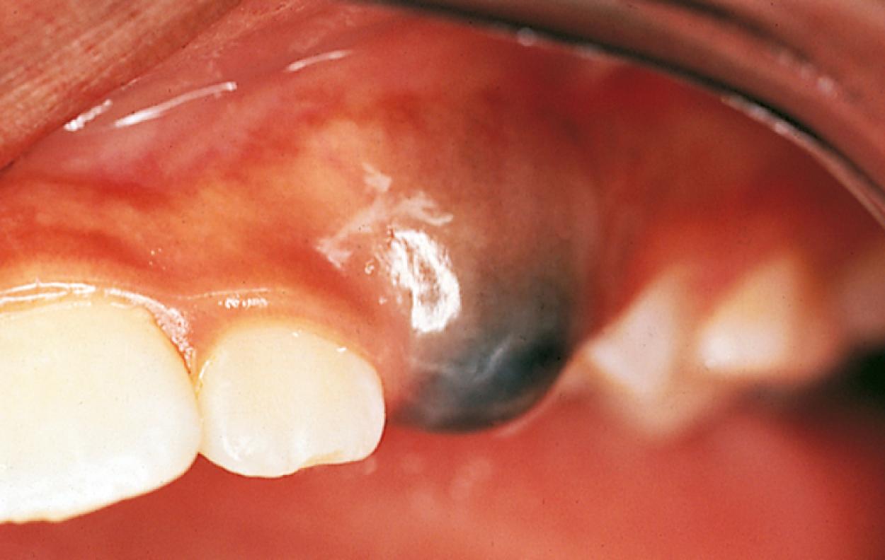 Fig. 21.25, Eruption hematoma. A bluish, fluid-filled, fluctuant swelling can be seen over the crown of an erupting maxillary cuspid. The lesion resolved without treatment when the tooth erupted.