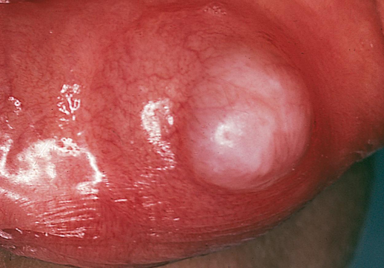 Fig. 21.26, A mucocele on the lower lip, with the characteristic translucent coloration secondary to fluid retention.