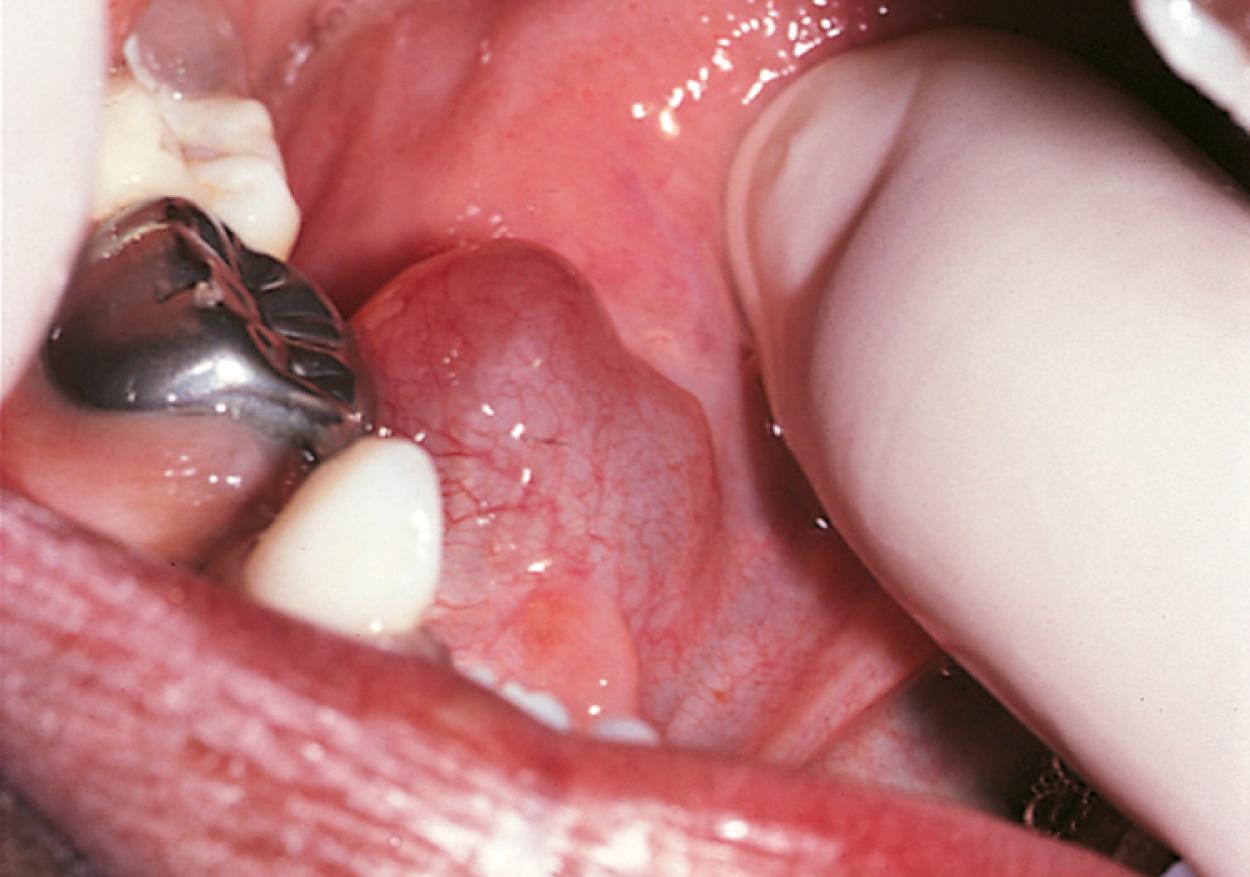 Fig. 21.27, Ranula. The bluish, fluctuant swelling in the floor of the mouth is a retention cyst associated with trauma to a salivary duct.