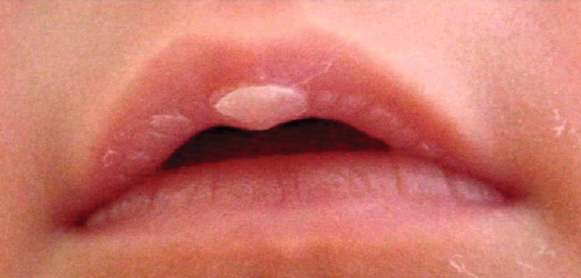 Fig. 21.3, A sucking callus present on the maxillary lip.