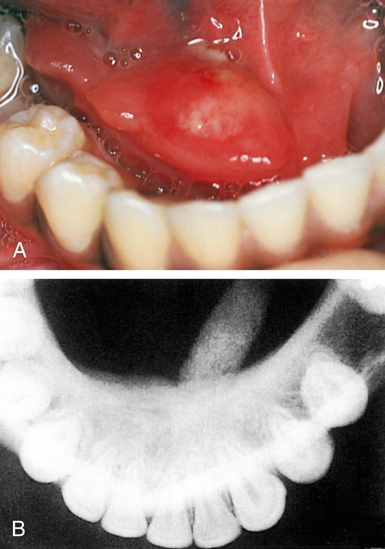 Fig. 21.28, Salivary calculus. (A) This sialolith obstructing a salivary duct is observed in the floor of the mouth. (B) A dental radiograph of the sublingual space reveals the size and location of the salivary calculus.