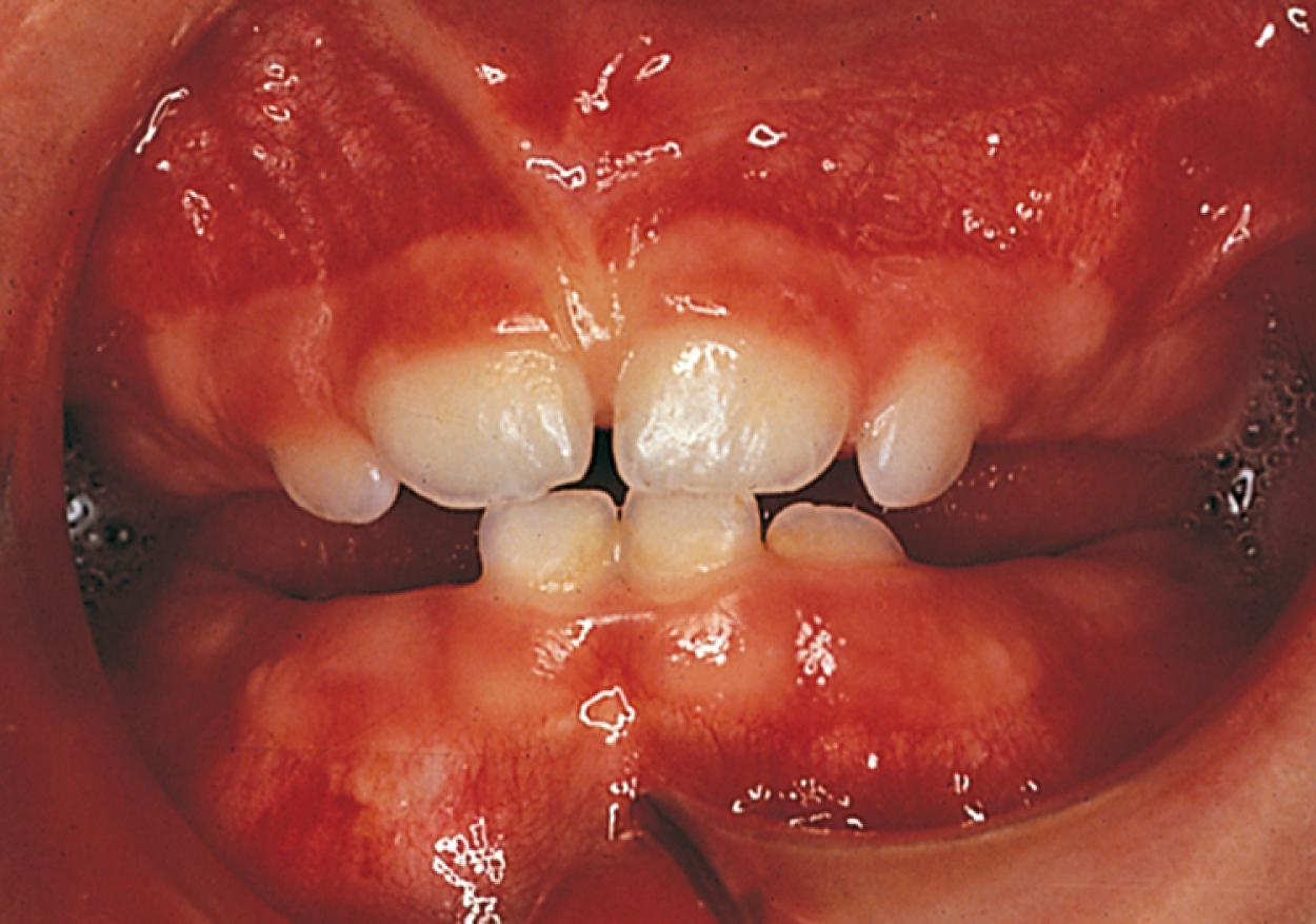 Fig. 21.4, Early primary dentition. The mandibular and maxillary central and lateral incisors are the first to erupt.