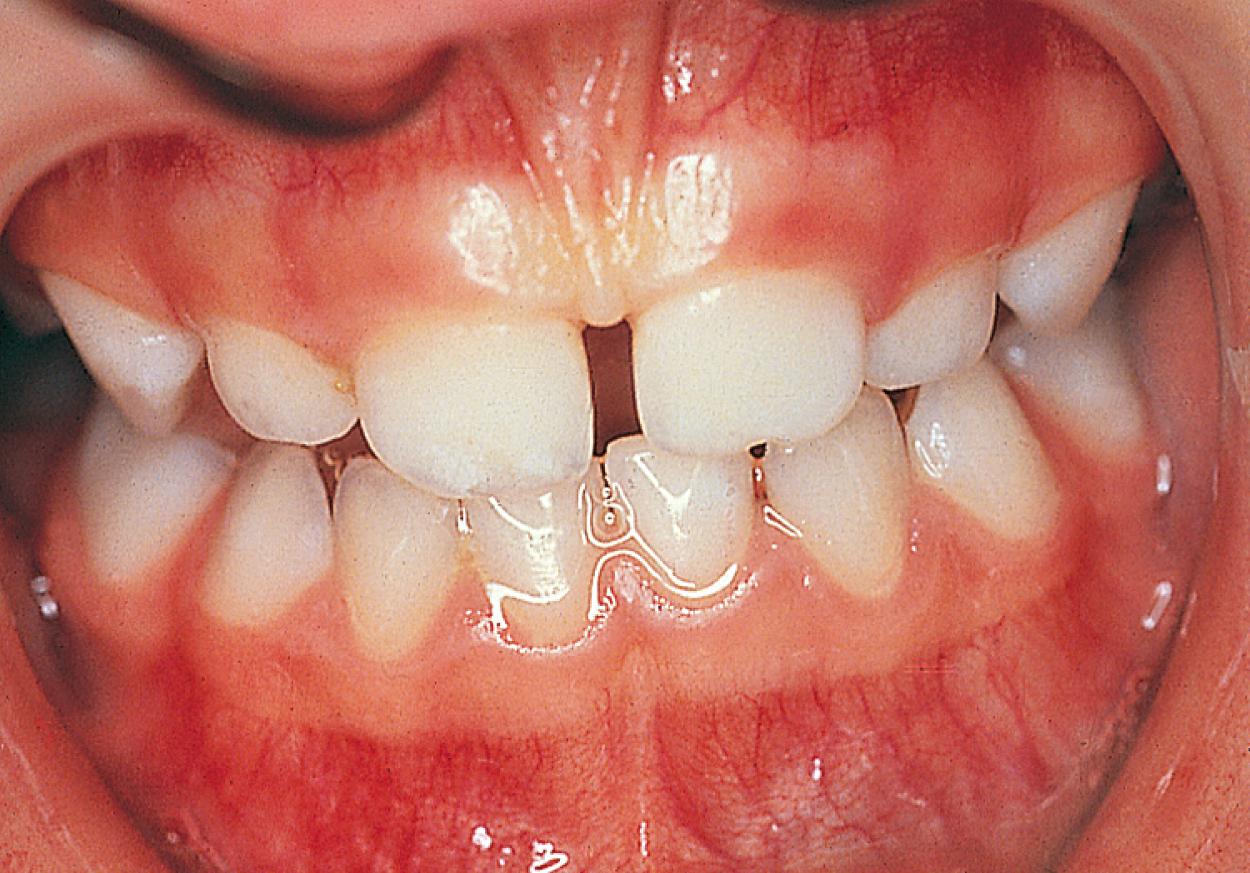 Fig. 21.5, Full primary dentition. By age 3, all 20 primary teeth have erupted.