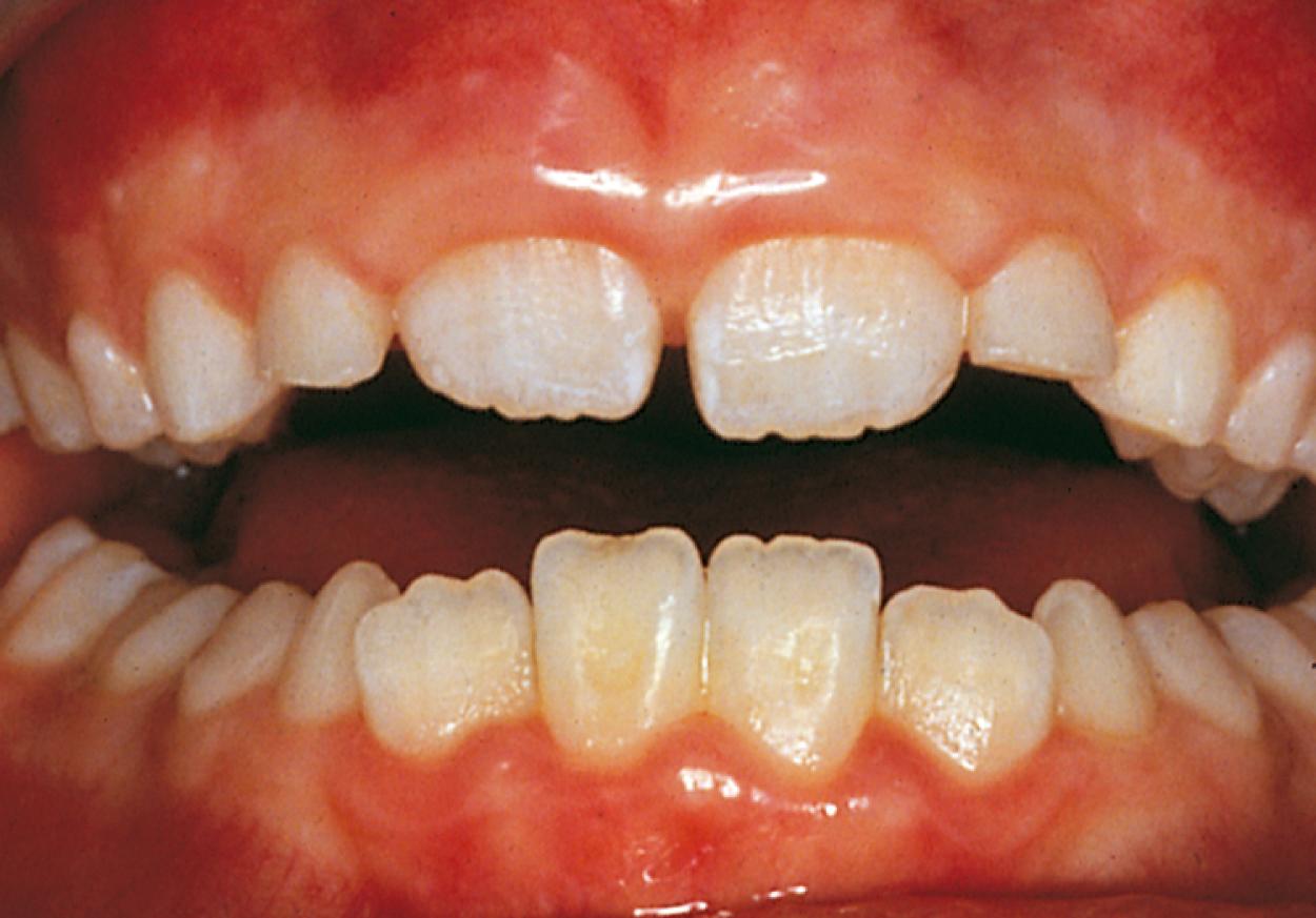 Fig. 21.6, Mixed dentition. This transitional stage from primary to permanent dentition begins at age 6 and lasts for about 6 years.