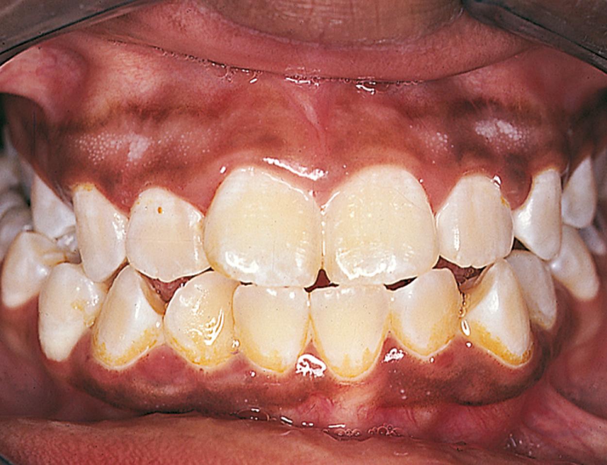 Fig. 21.9, Gingivitis during puberty. The gingival tissues are mildly erythematous and edematous, and they tend to bleed easily with brushing. Hormonal changes and inattention to careful dental hygiene are thought to be contributory.