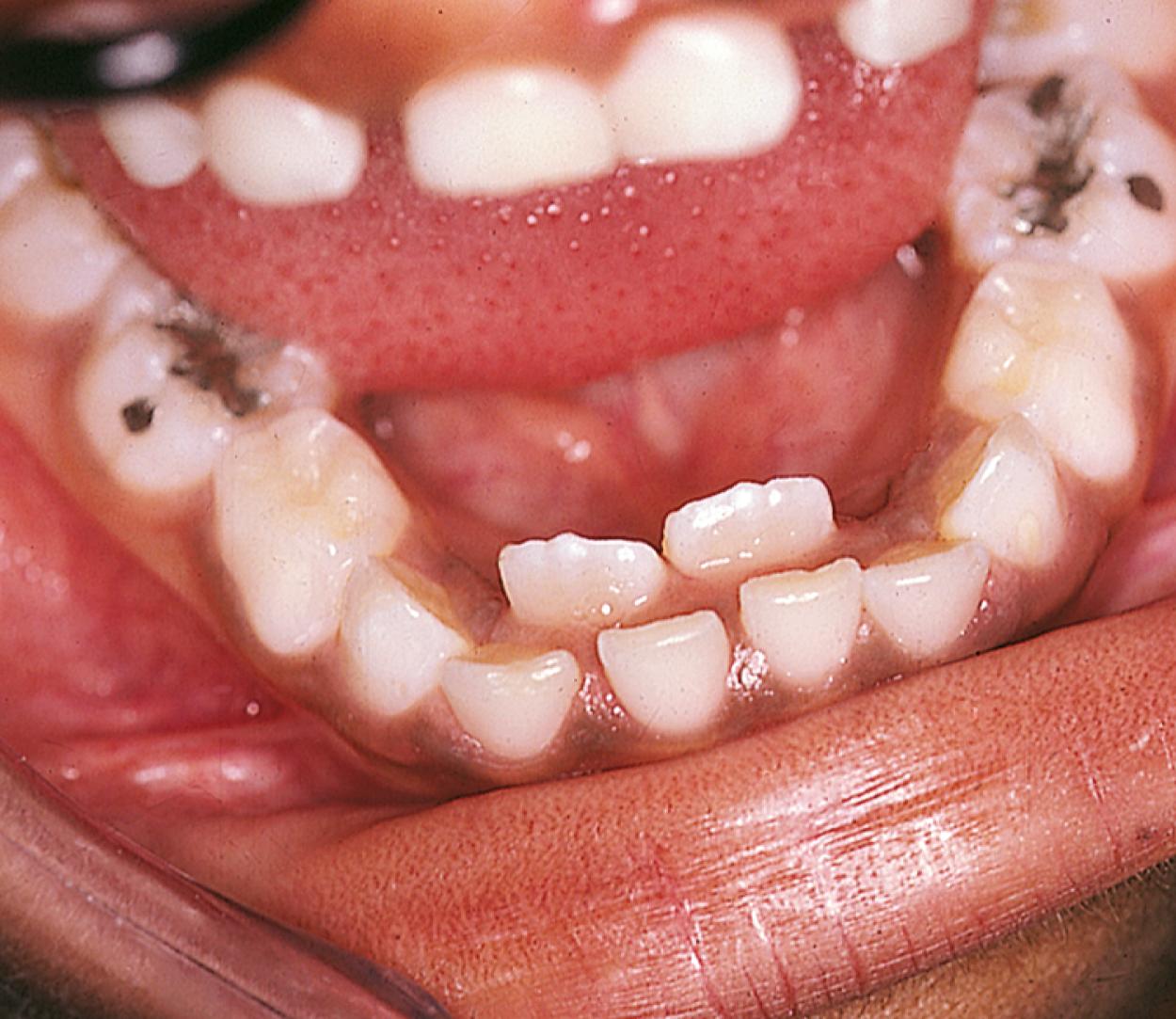 Fig. 21.7, Abnormal eruption patterns frequently occur in the early mixed dentition phase. One example is shown here, with eruption of the permanent central incisors behind the primary teeth.