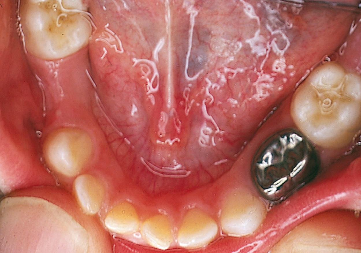 Fig. 21.43, The occlusal surfaces of newly erupted molars exhibit varying degrees of pit and fissure depth. The morphology of these patterns makes these teeth more prone to early decay.