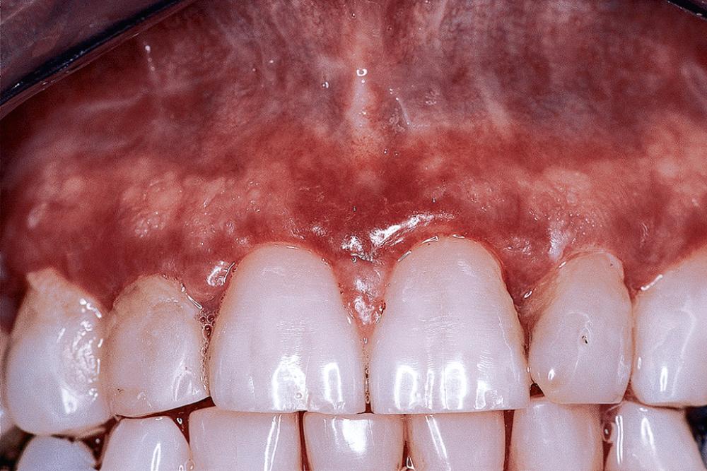 Fig. 87.11, Atrophic lichen planus with characteristic erythema and edema, loss of surface keratinization, and an overall glassy appearance.