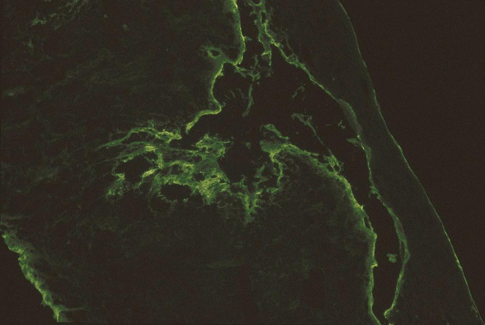 Fig. 87.14, Fibrinogen reactivity at the basement membrane zone characterizes the direct immunofluorescence findings in lichen planus.